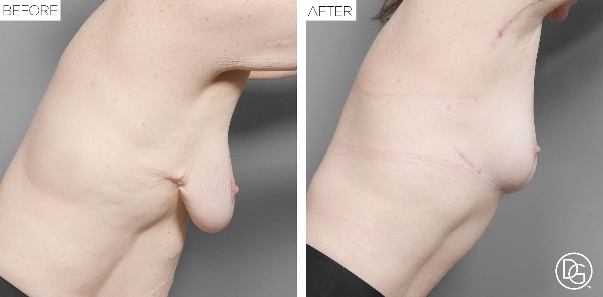 Breast Revision Before & After Image