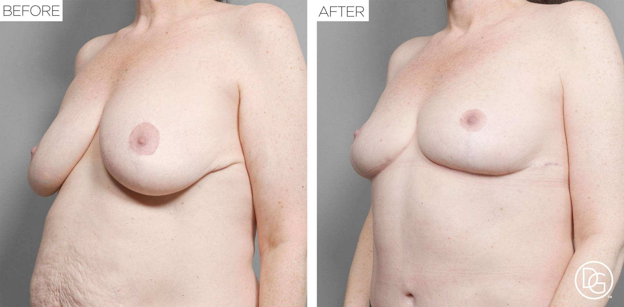 Breast Revision Before & After Image