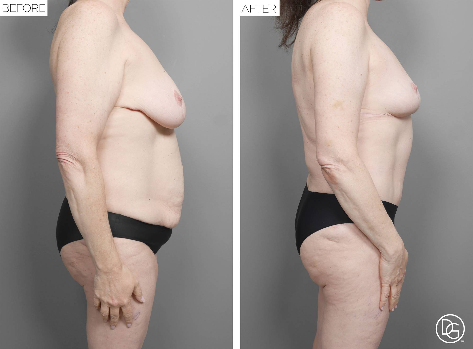 Mommy Makeover Before & After Image