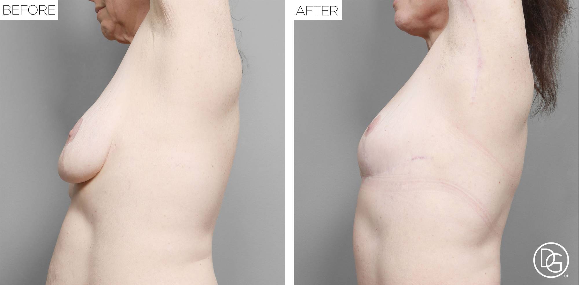 Breast Revision Before & After Image