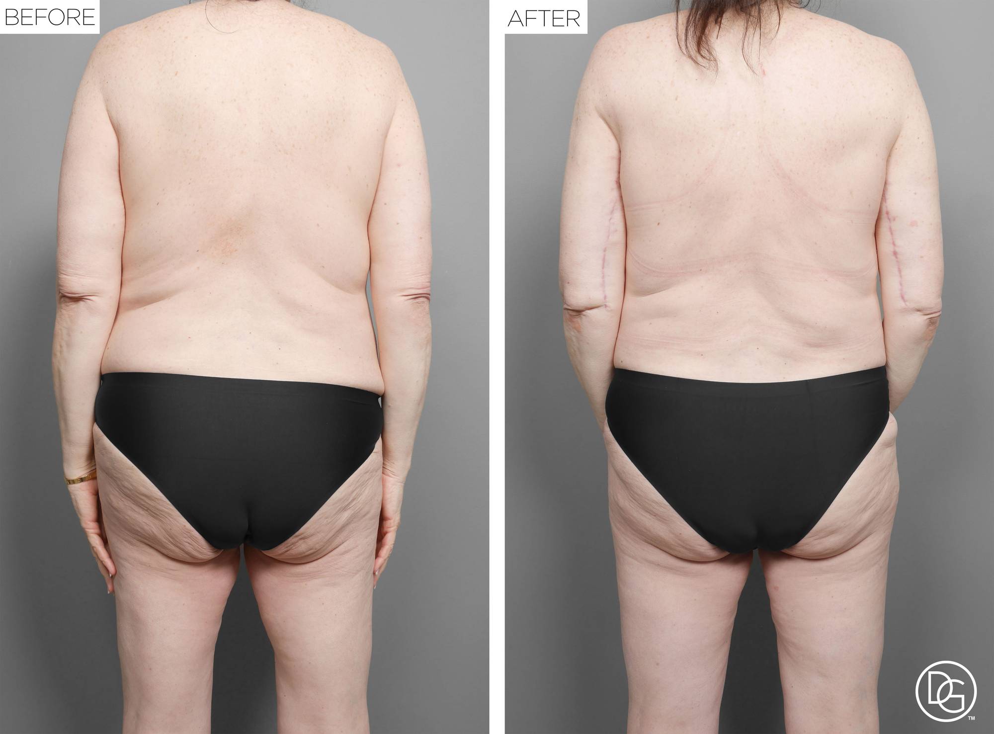 Mommy Makeover Before & After Image