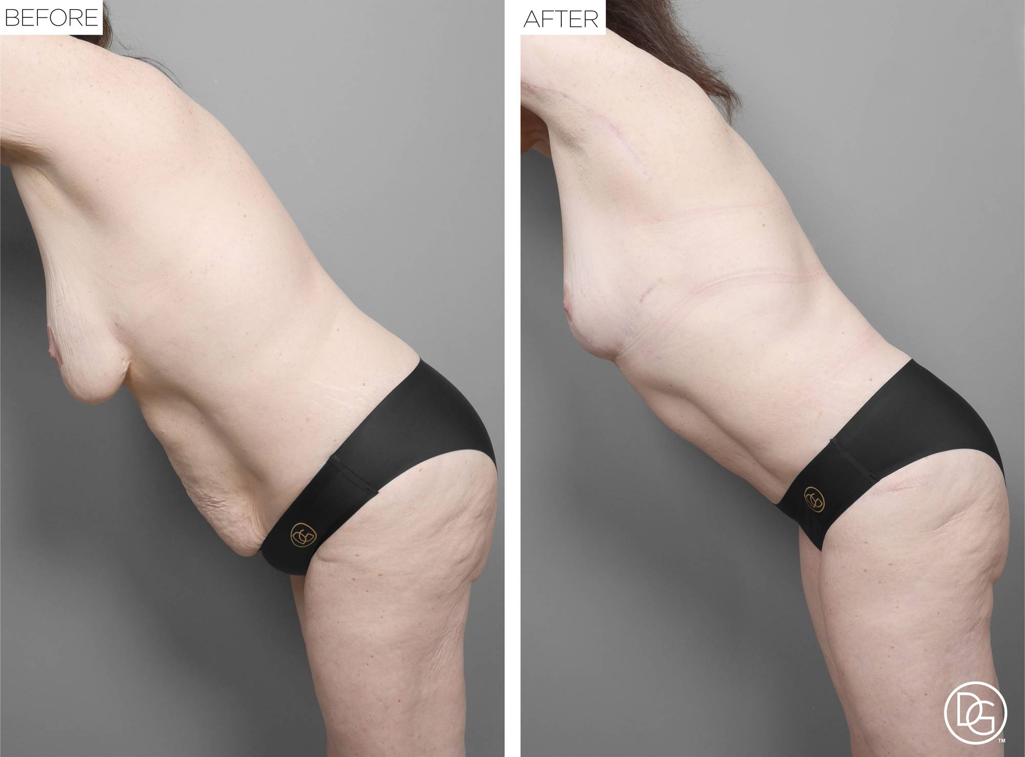 Mommy Makeover Before & After Image