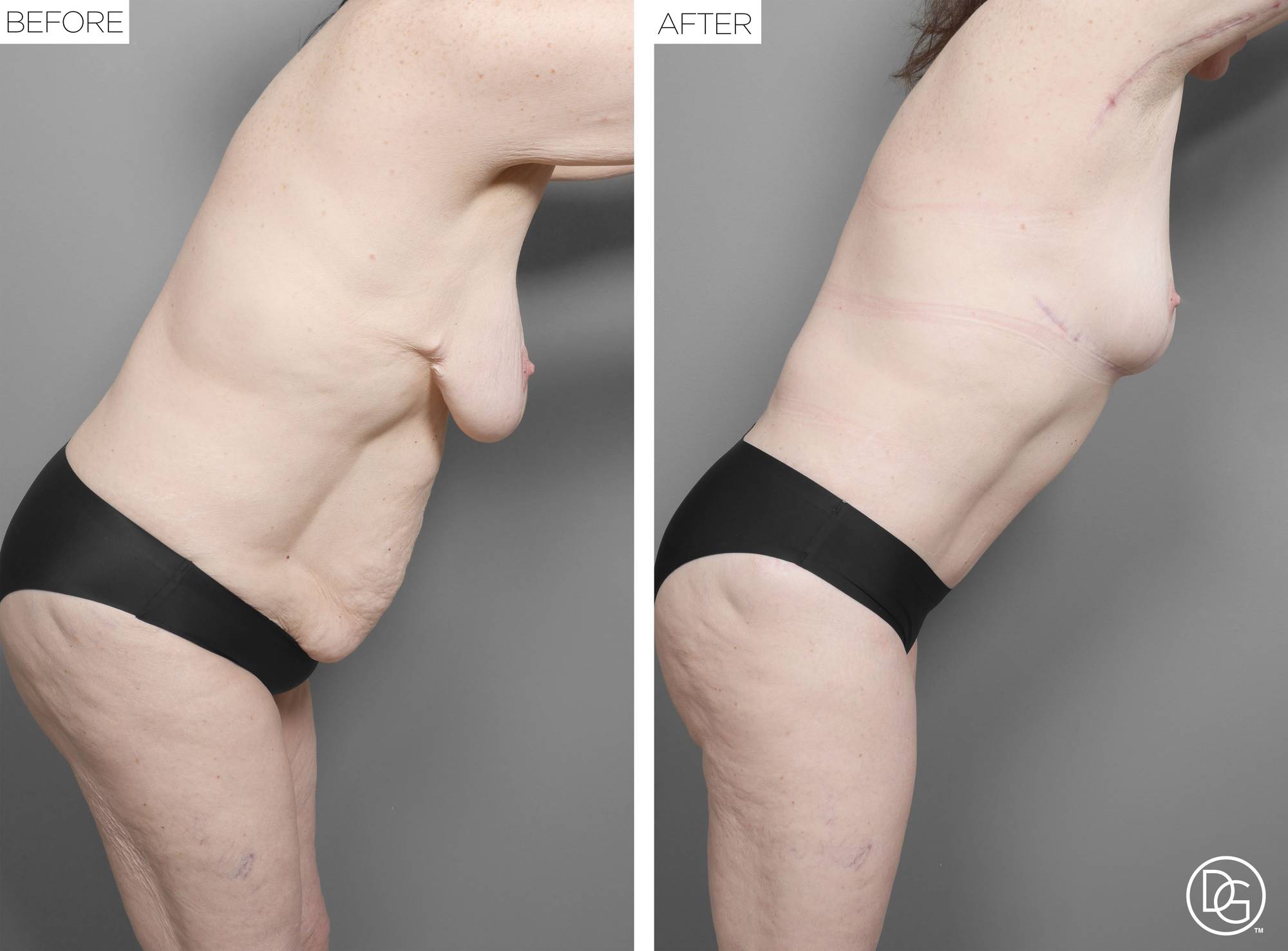 Mommy Makeover Before & After Image