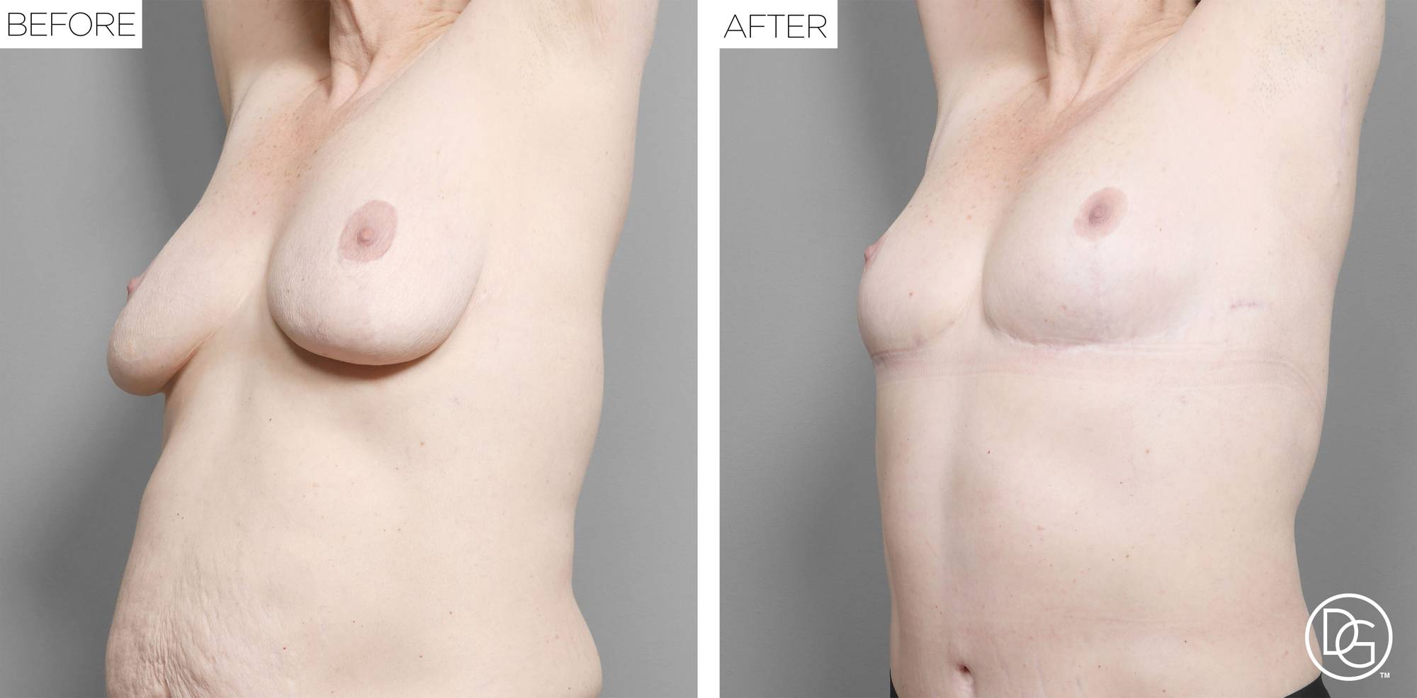 Breast Revision Before & After Image