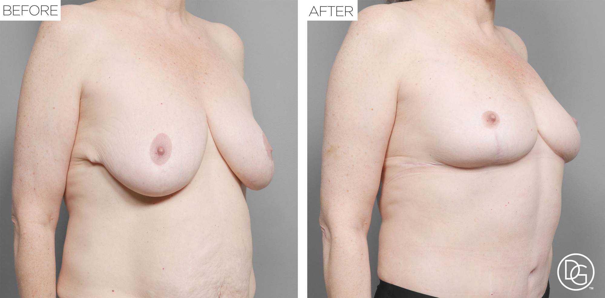 Breast Revision Before & After Image