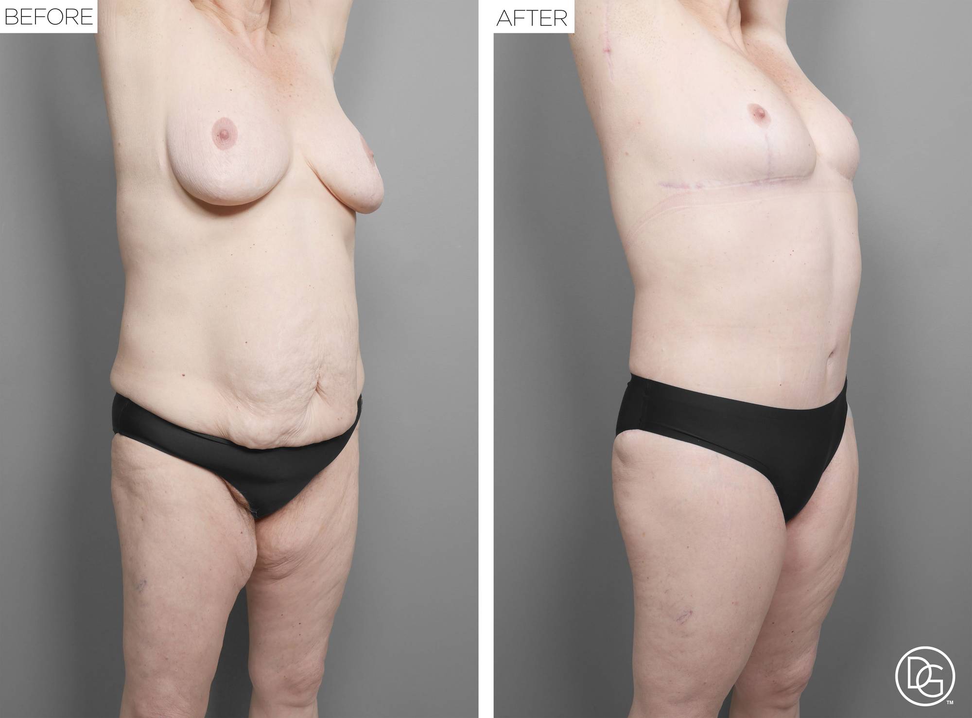 Mommy Makeover Before & After Image