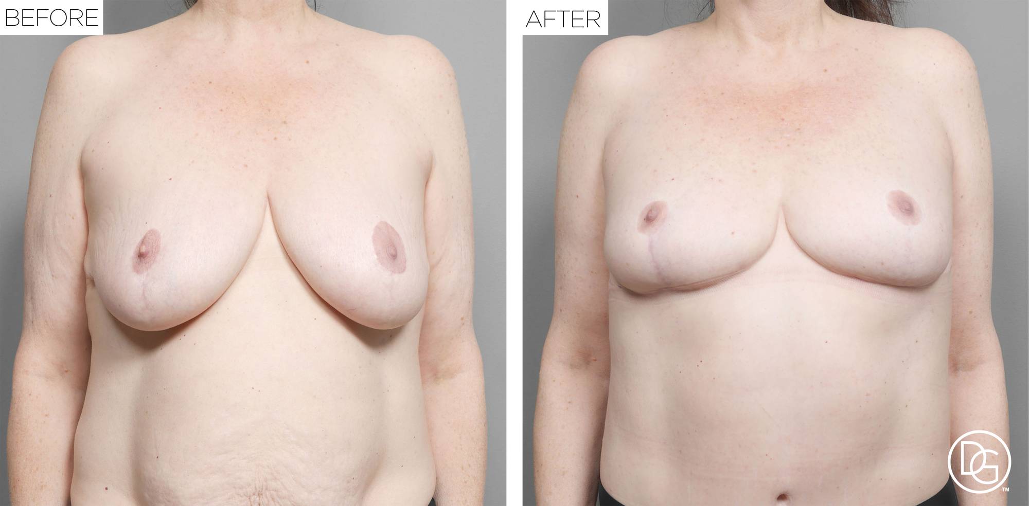 Breast Revision Before & After Image