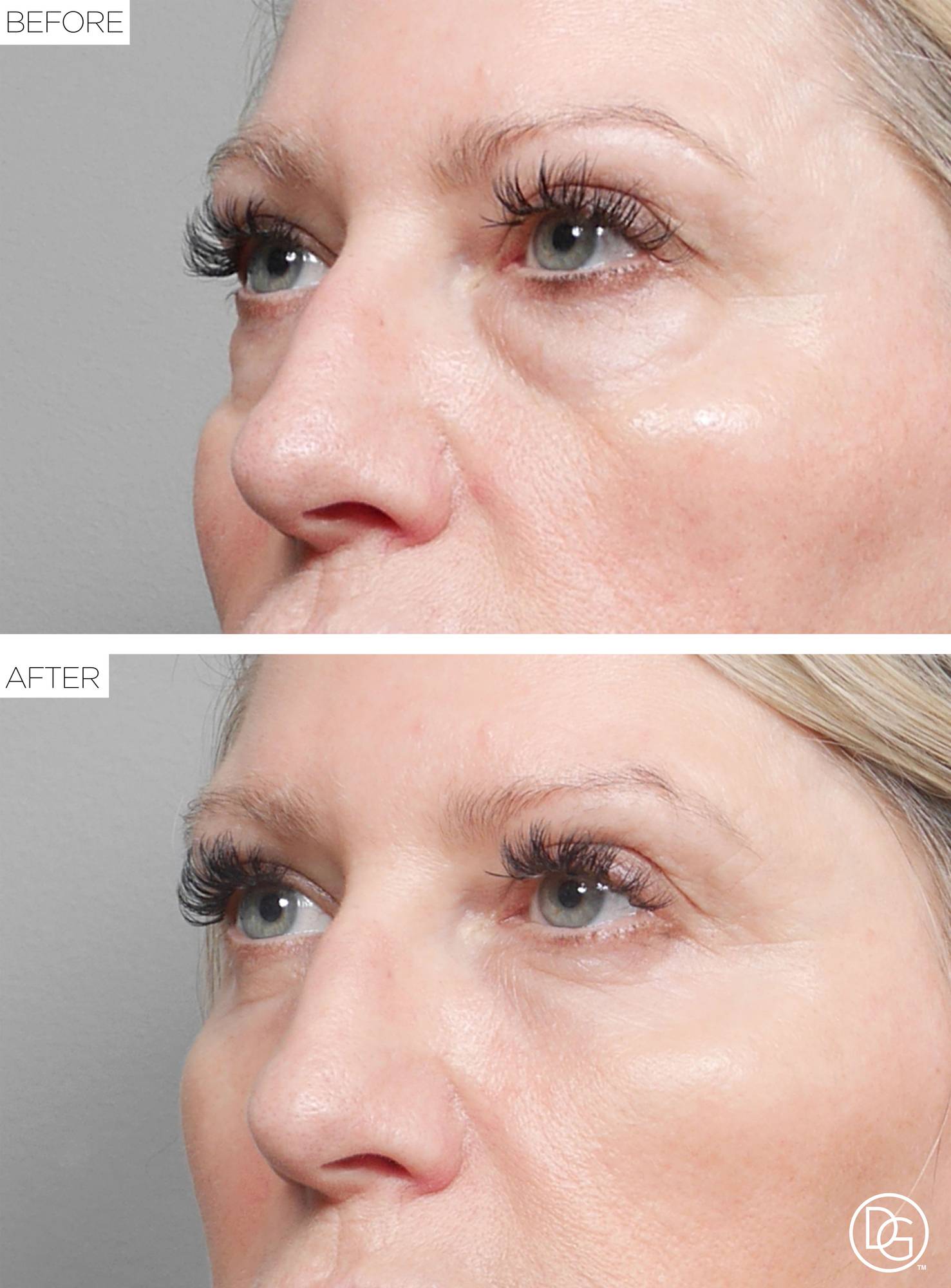Blepharoplasty Before & After Image