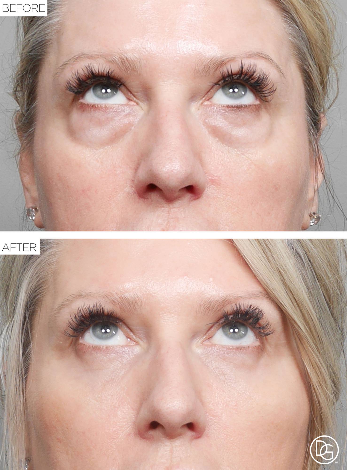 Blepharoplasty Before & After Image