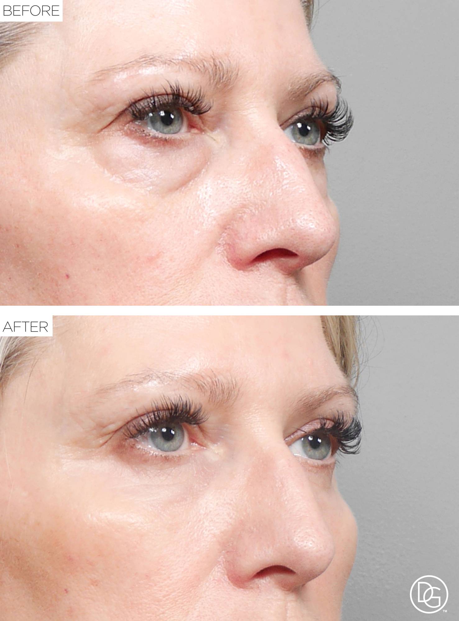 Blepharoplasty Before & After Image