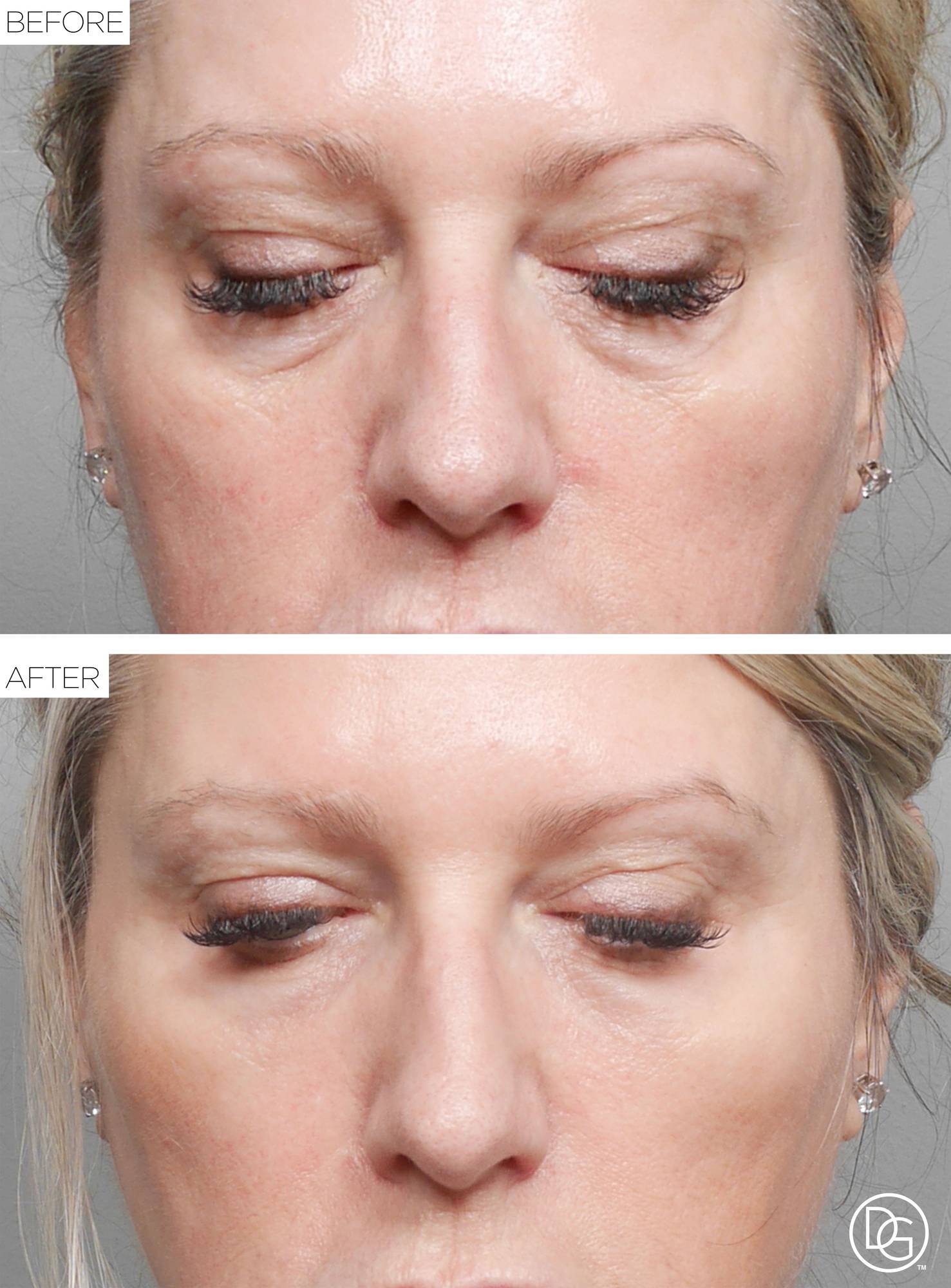 Blepharoplasty Before & After Image