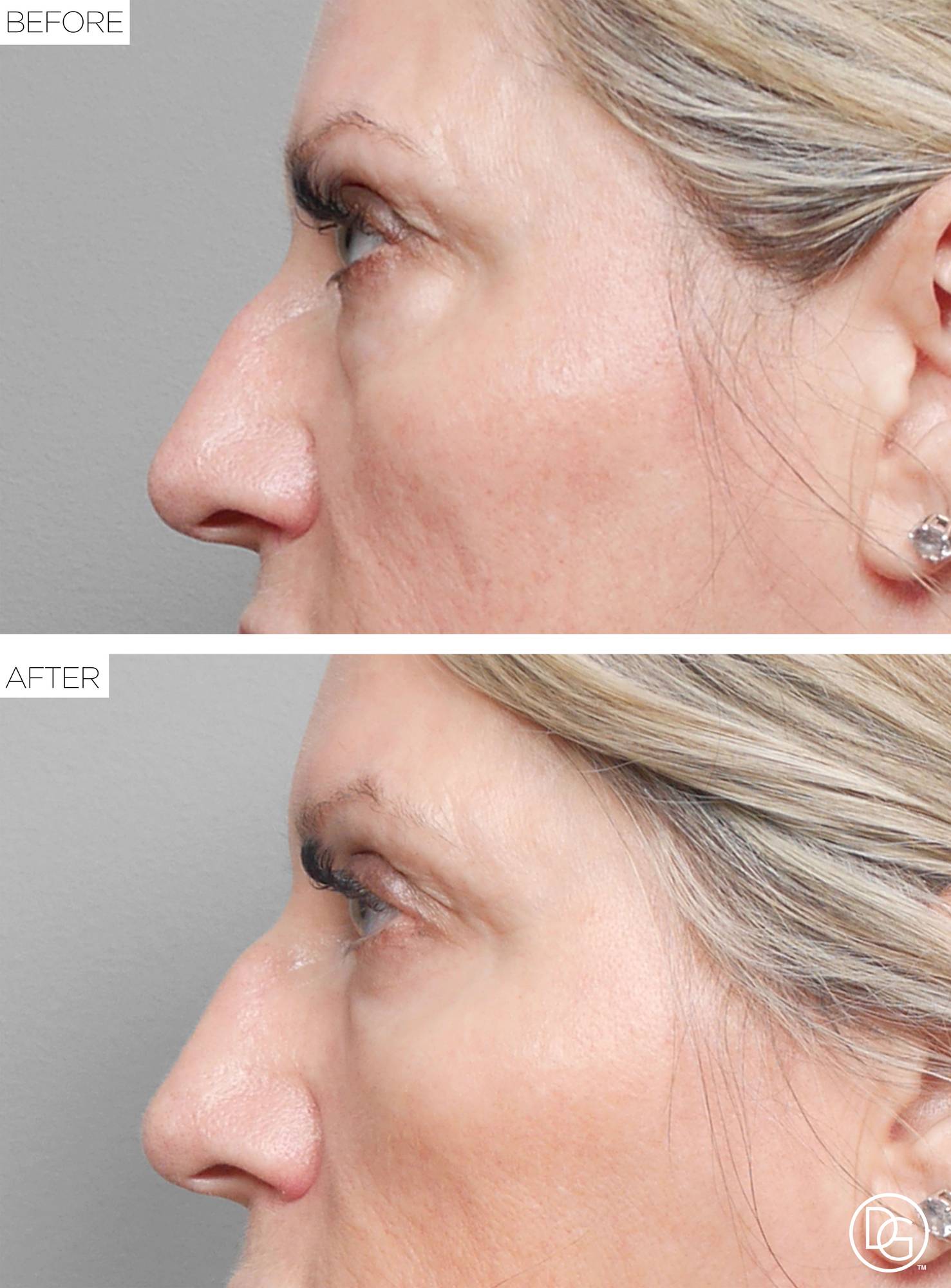 Blepharoplasty Before & After Image