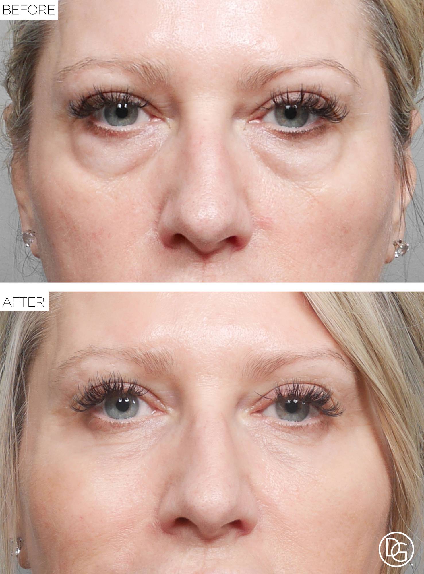 Blepharoplasty Before & After Image
