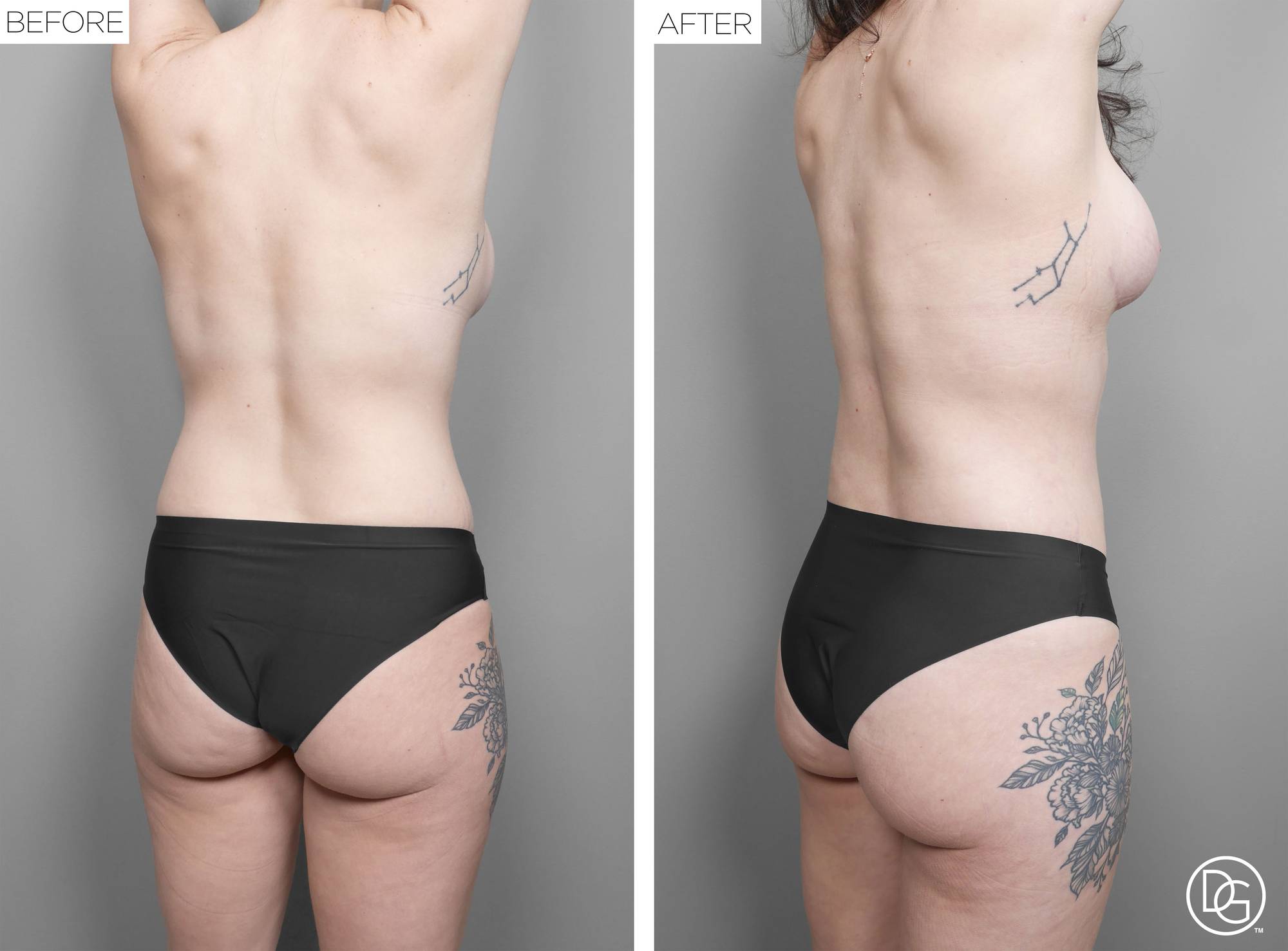 Liposuction Before & After Image