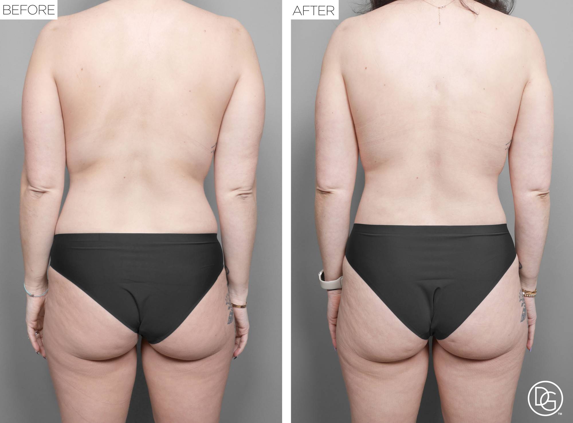 Liposuction Before & After Image