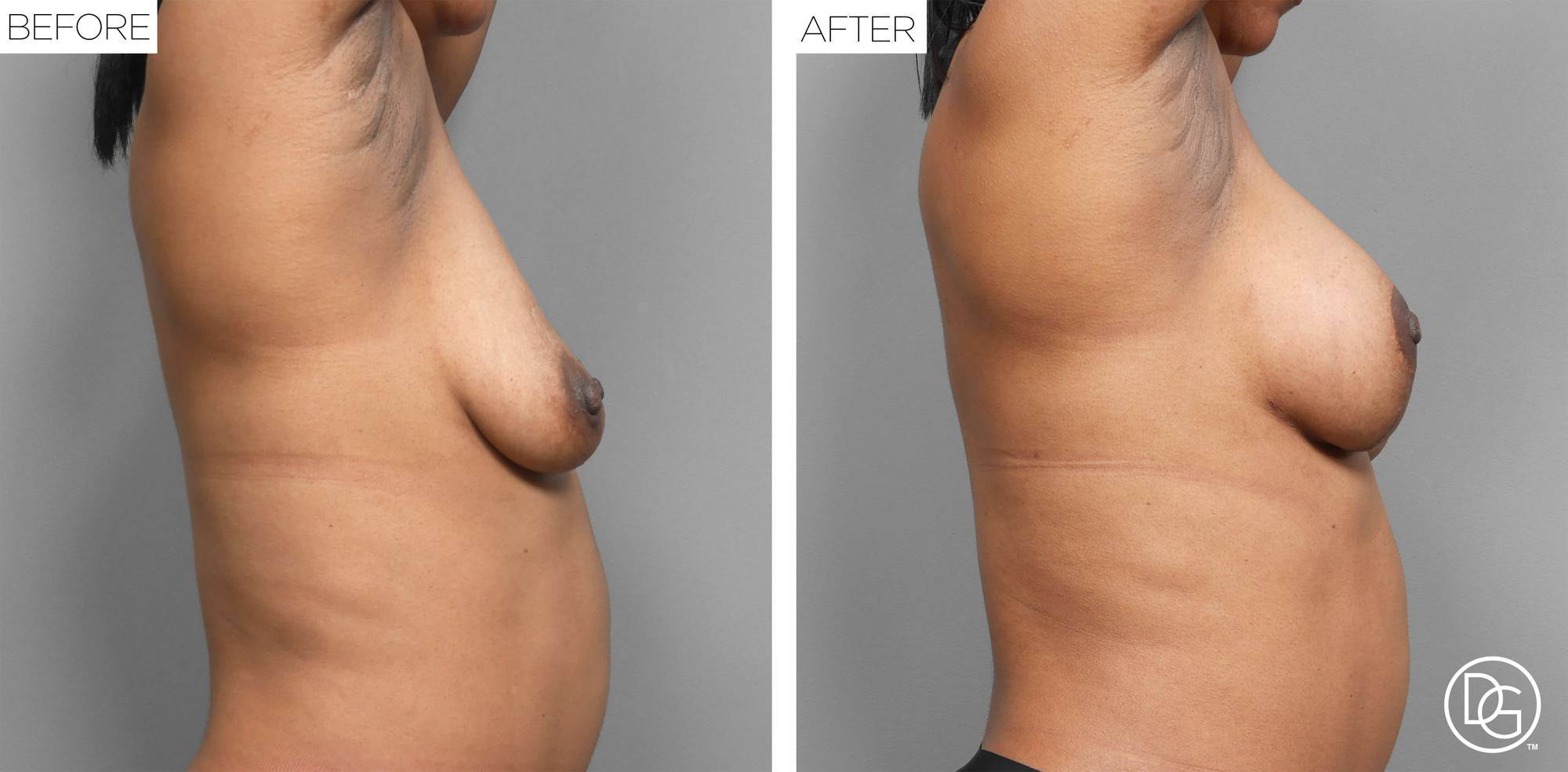 Breast Lift Before & After Image