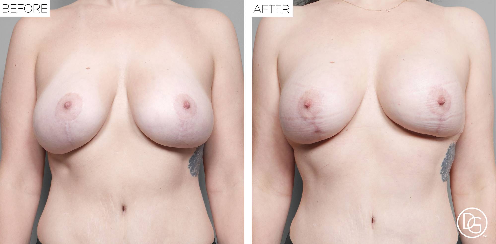 Breast Revision Before & After Image