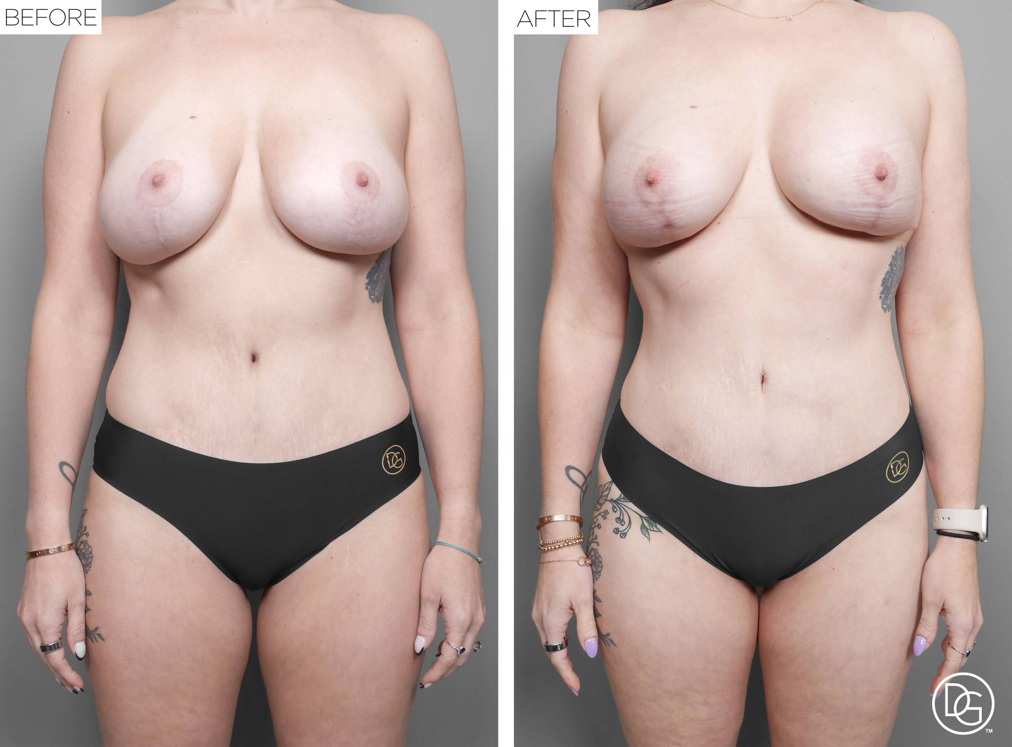 Liposuction Before & After Image