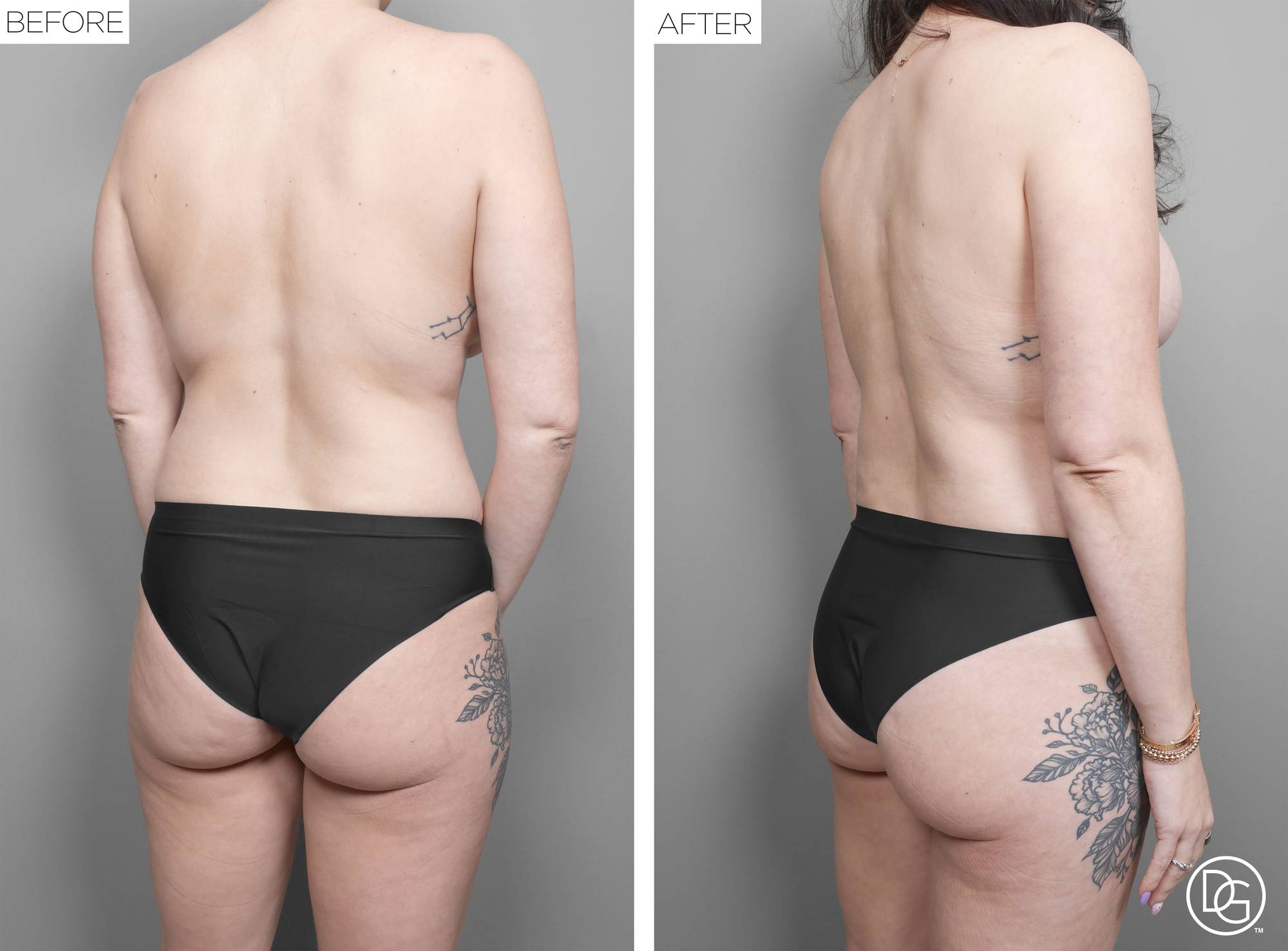 Liposuction Before & After Image