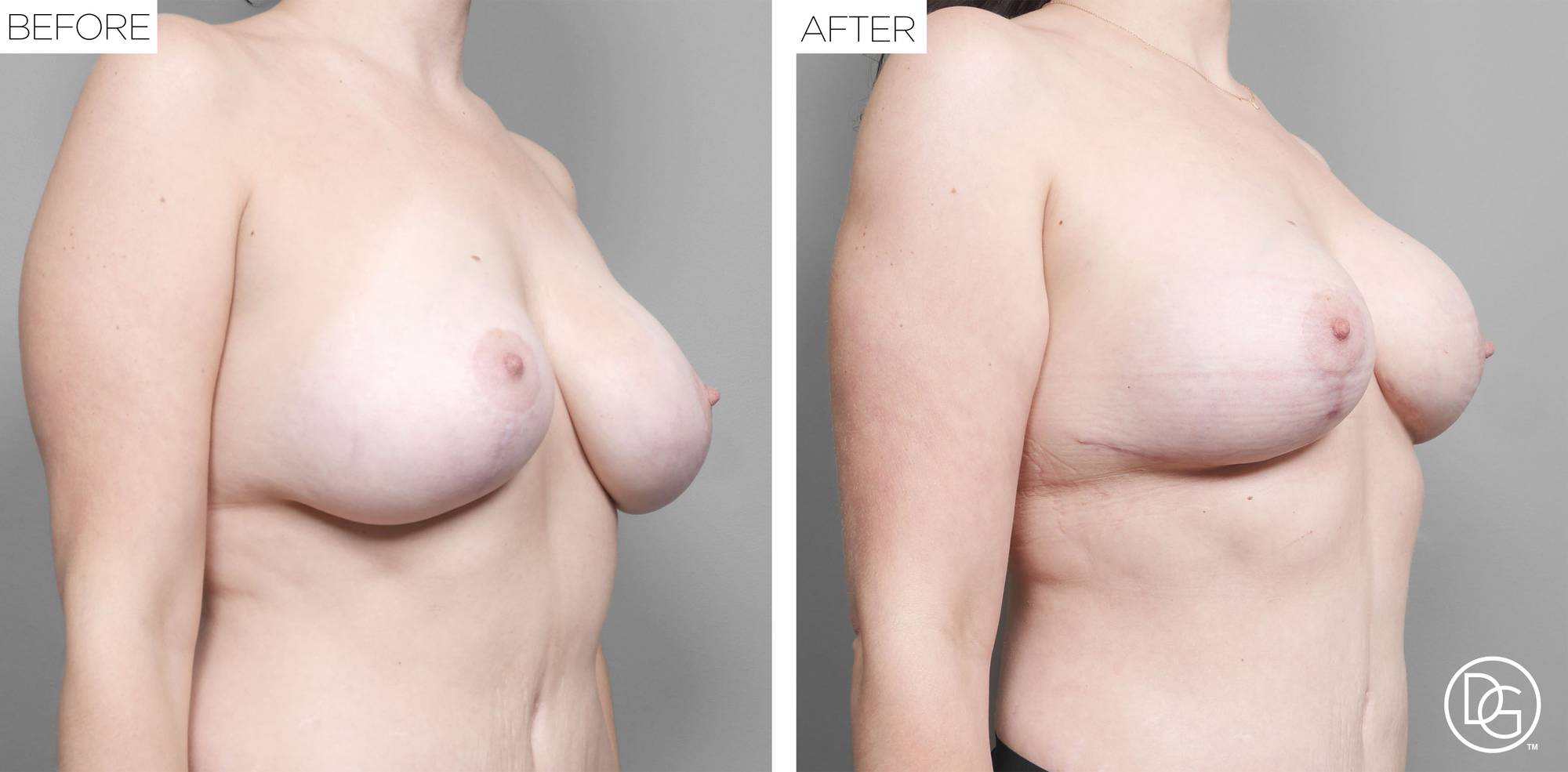 Breast Revision Before & After Image