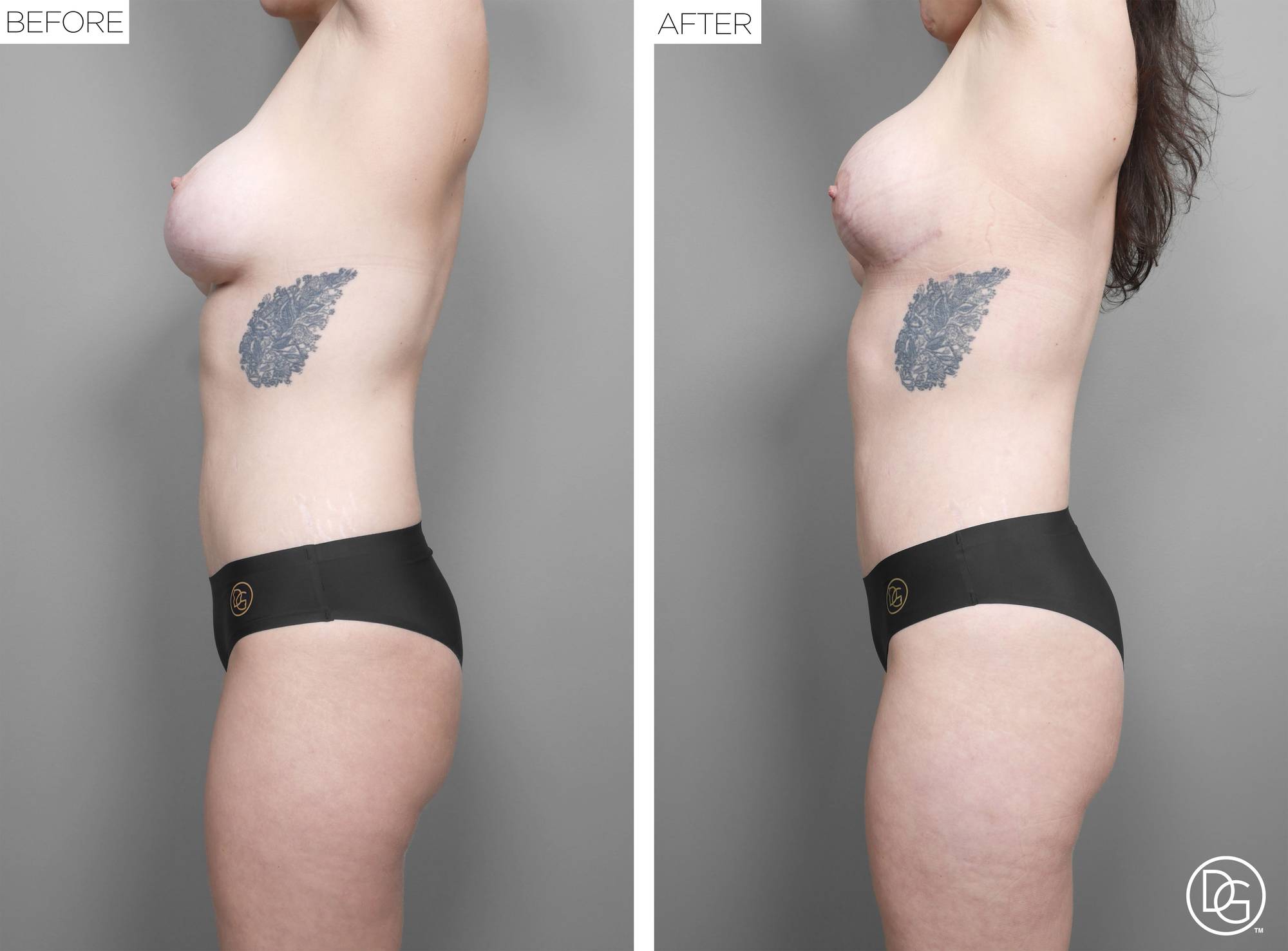 Liposuction Before & After Image