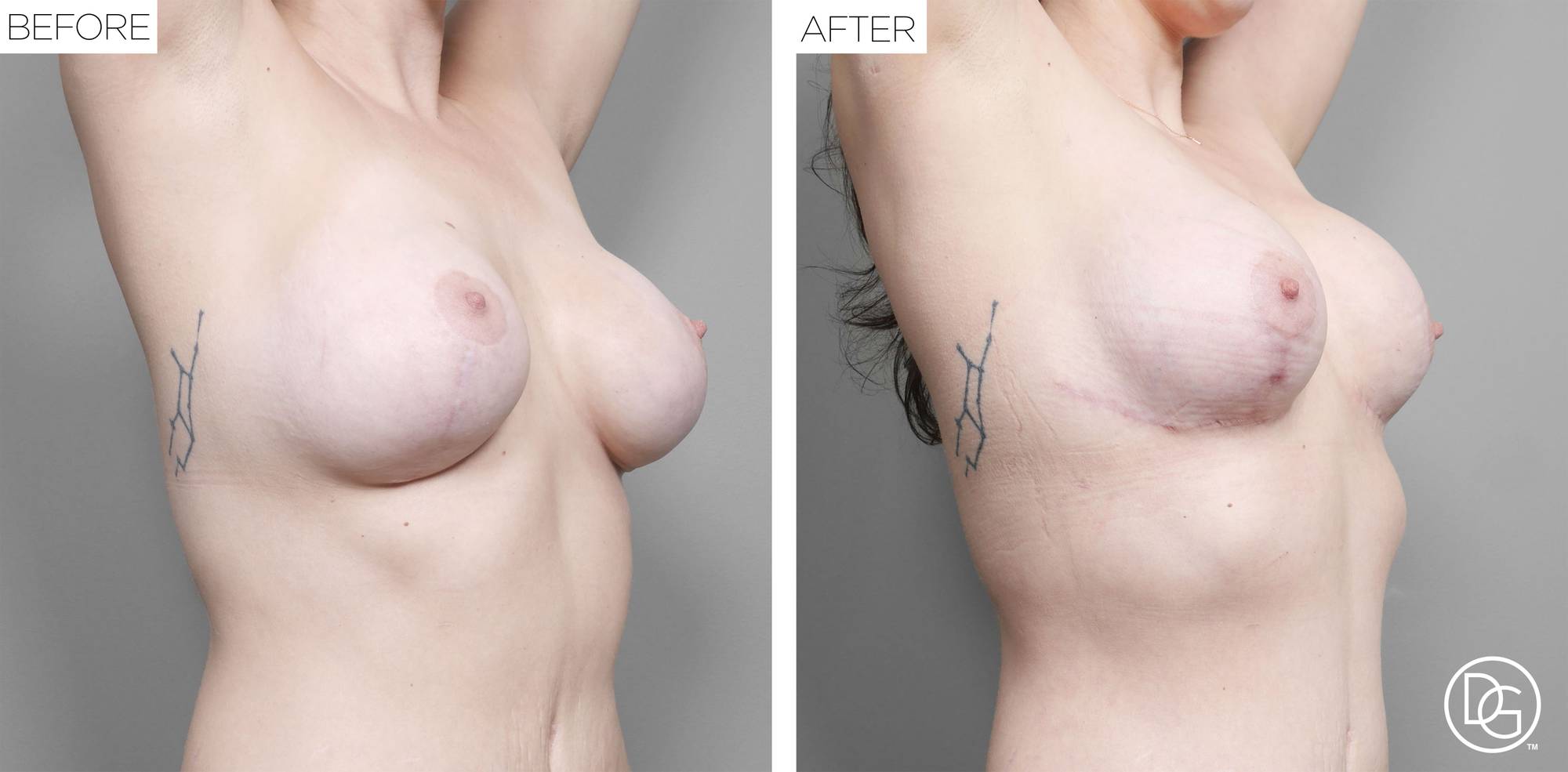 Breast Revision Before & After Image
