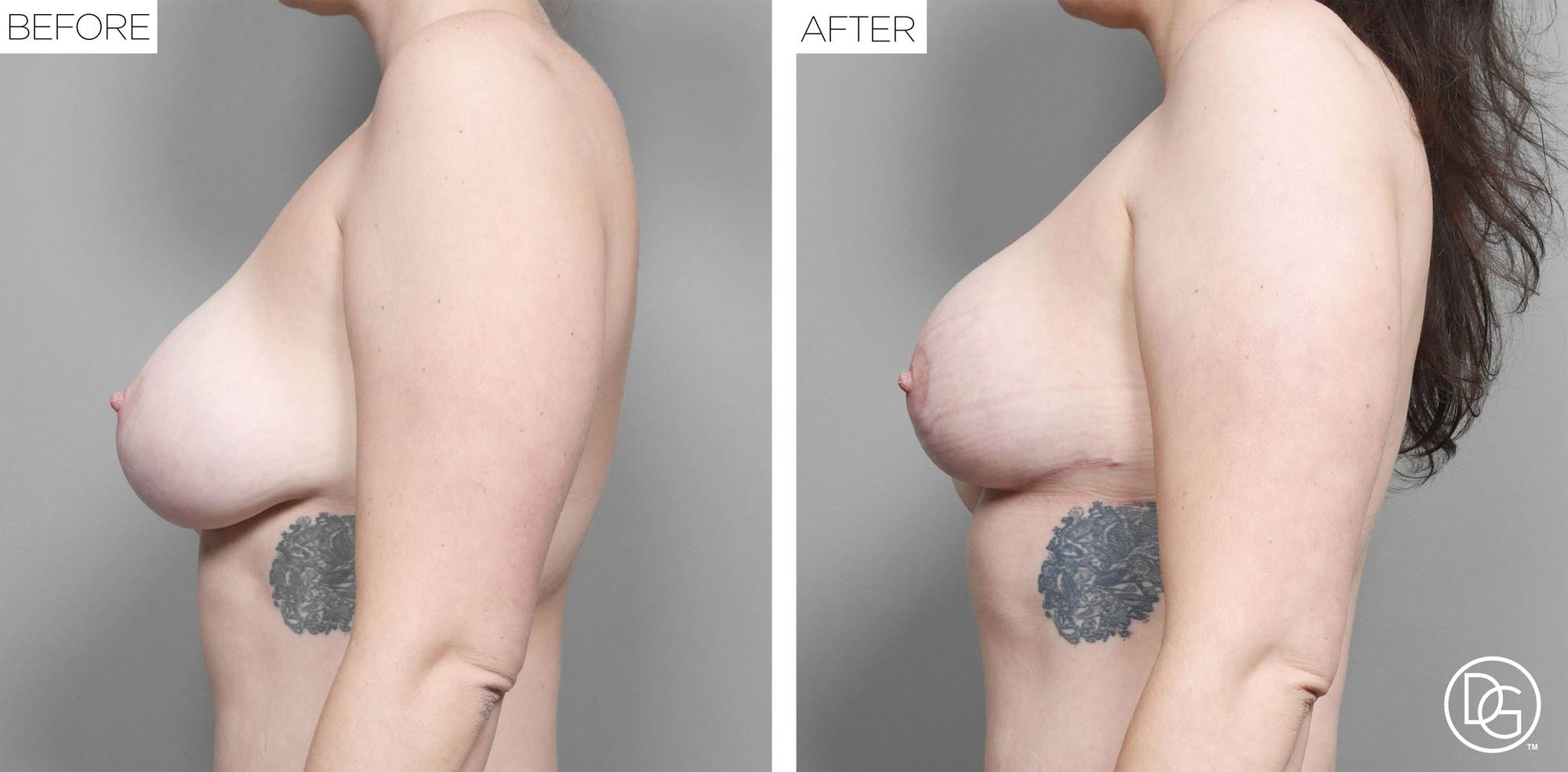 Breast Revision Before & After Image