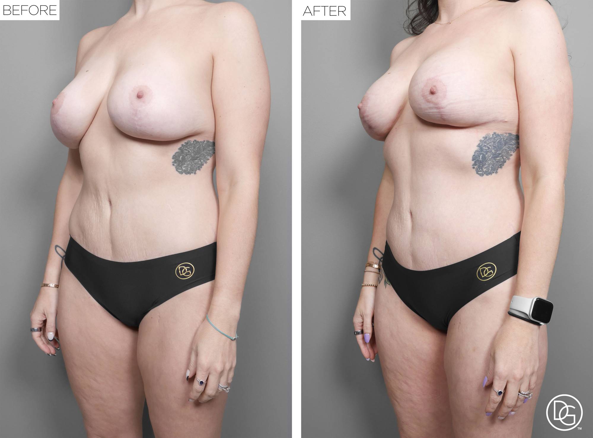 Liposuction Before & After Image