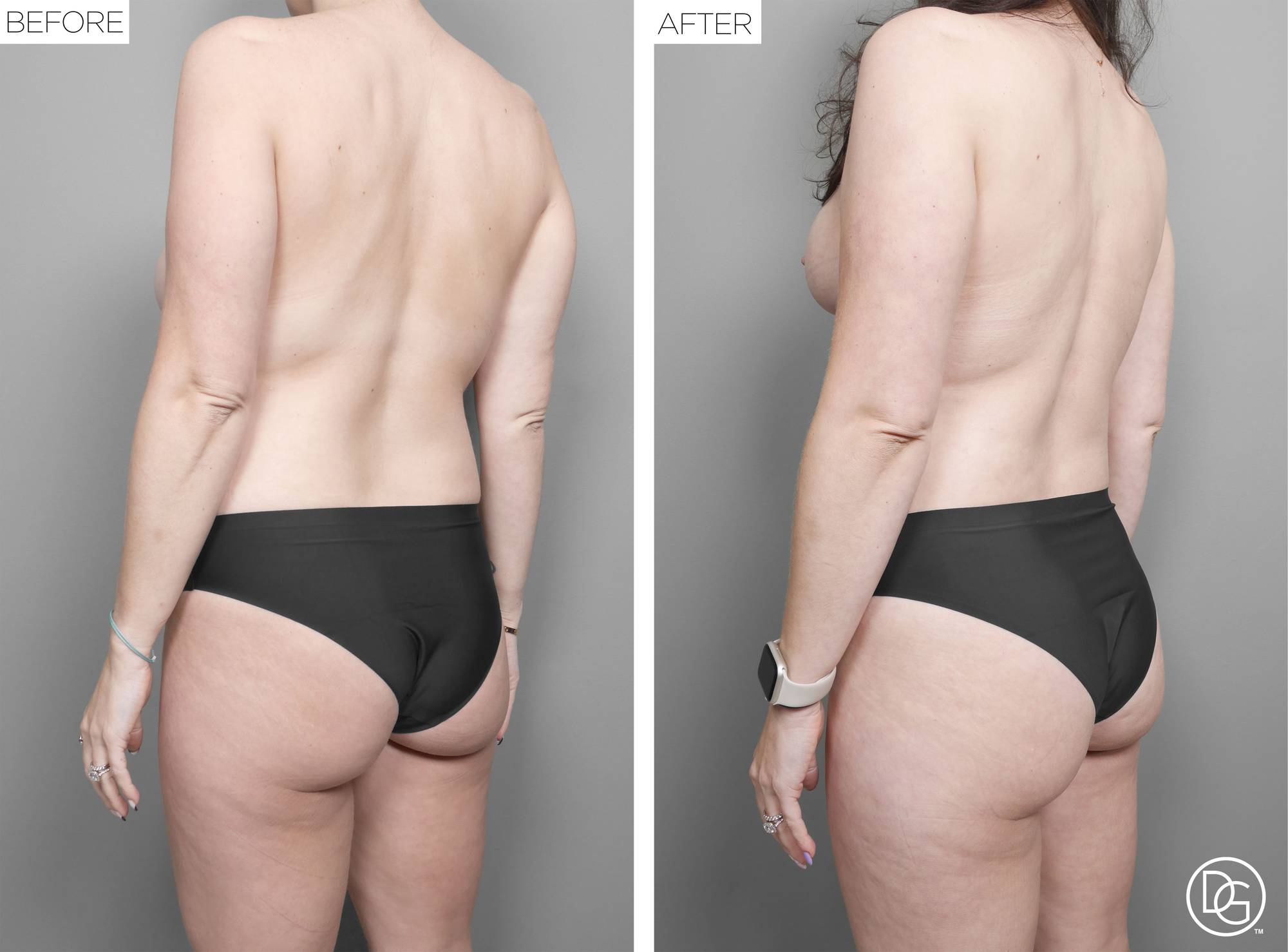Liposuction Before & After Image