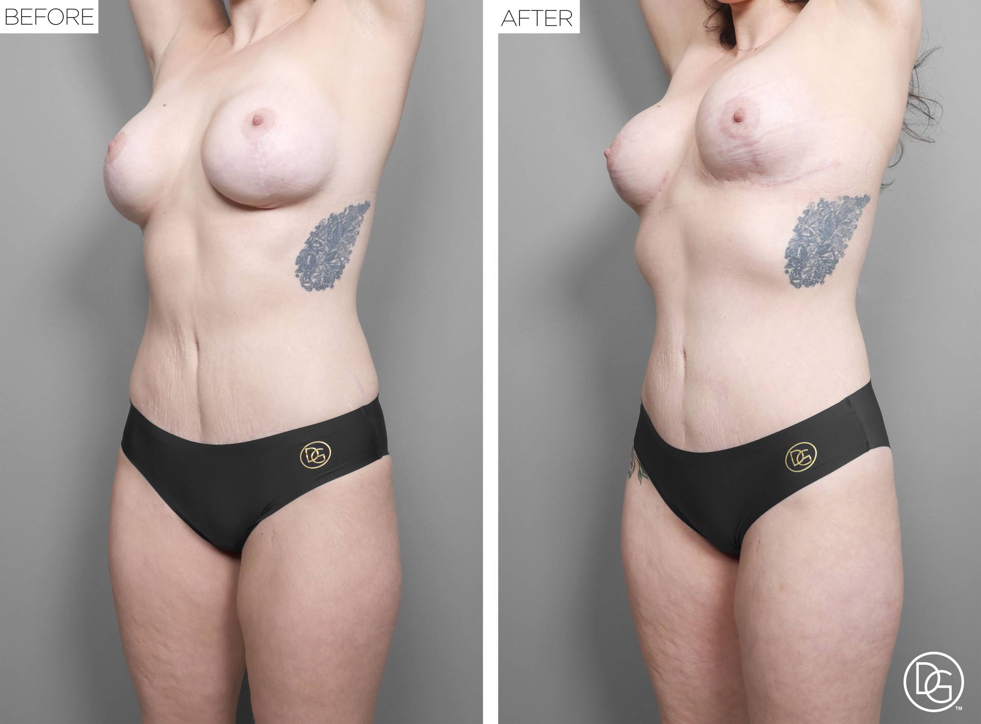 Liposuction Before & After Image