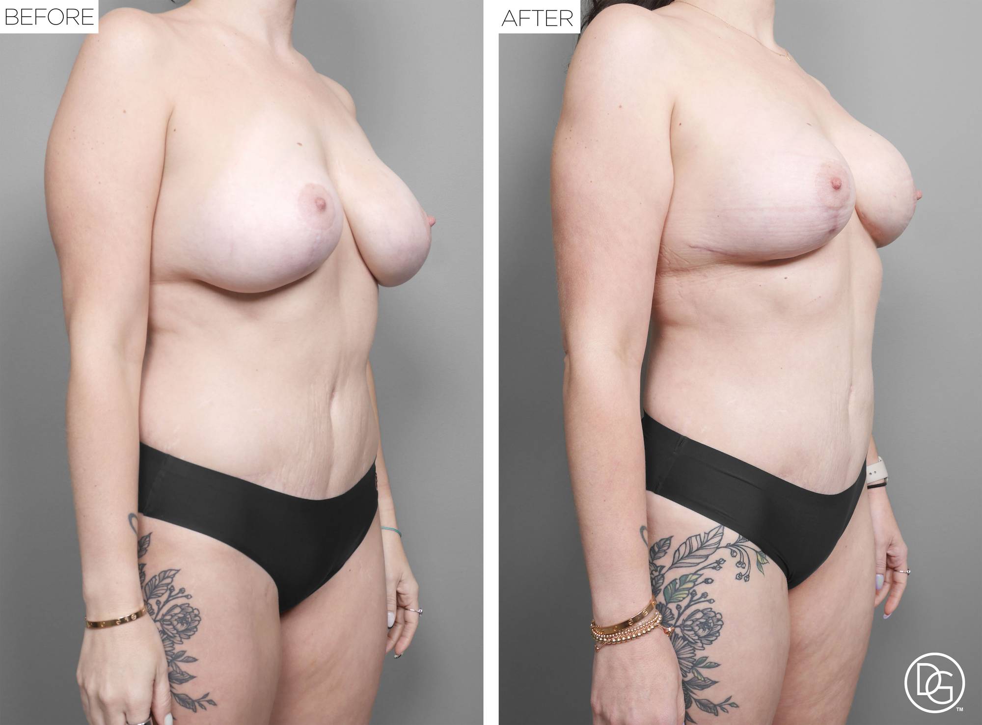 Liposuction Before & After Image