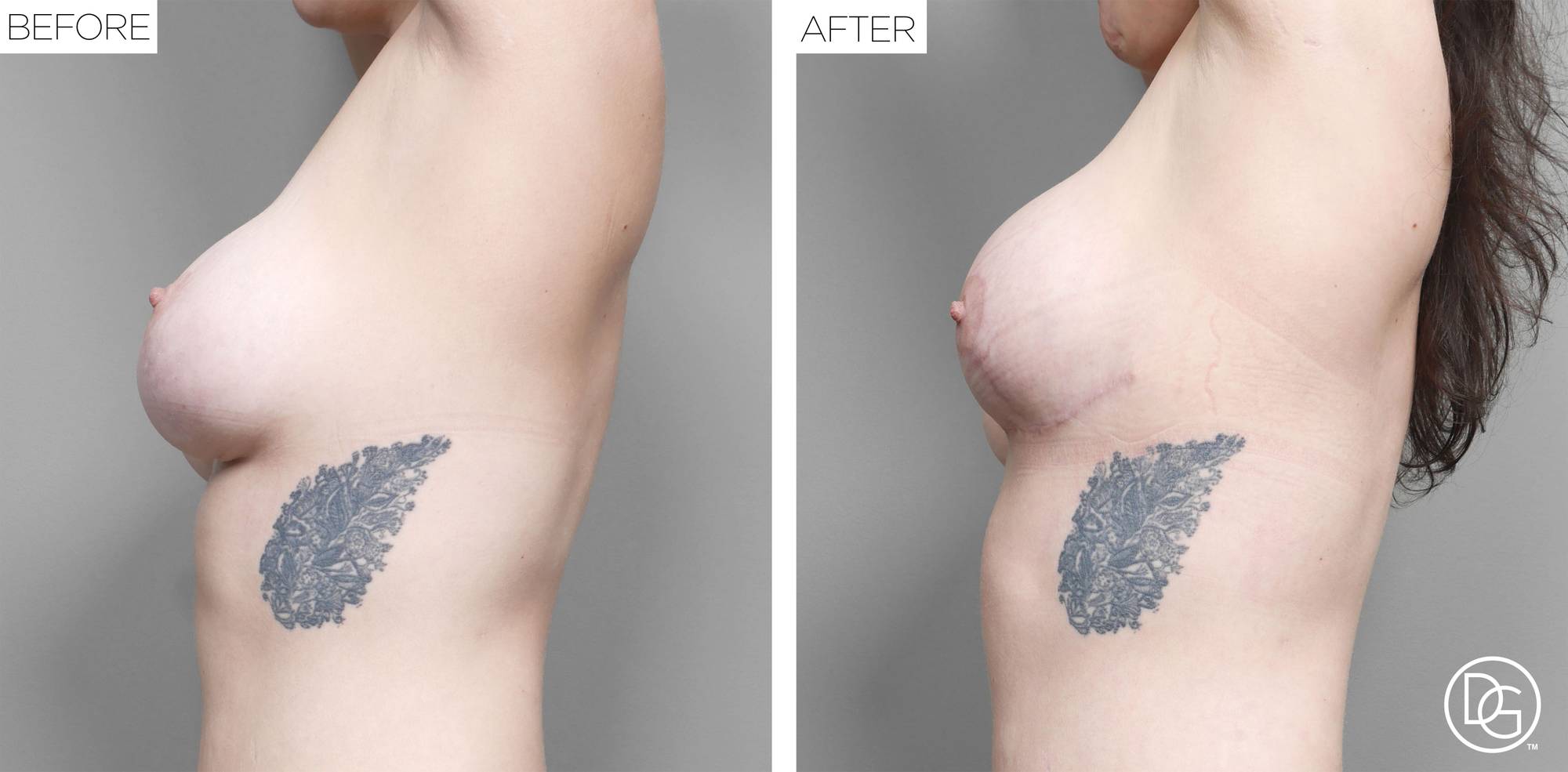 Breast Revision Before & After Image