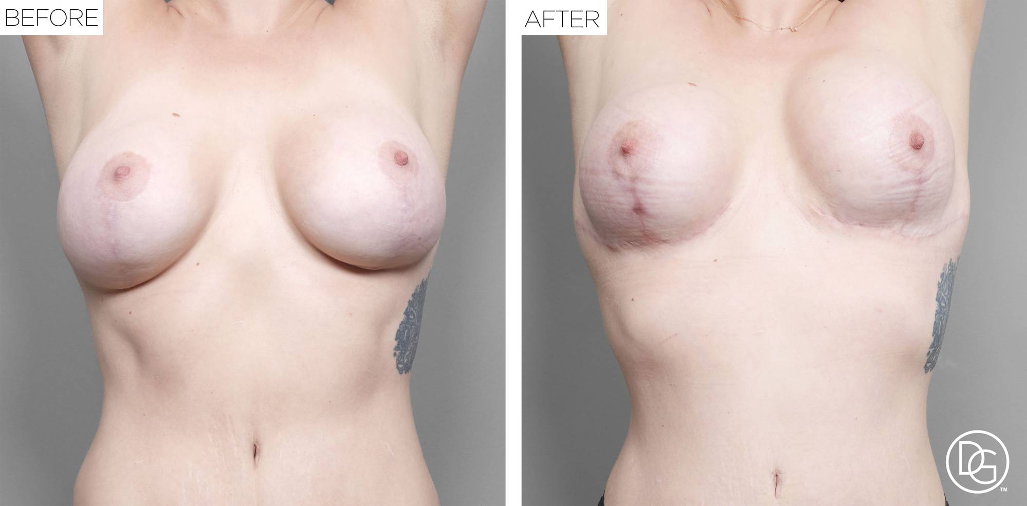 Breast Revision Before & After Image
