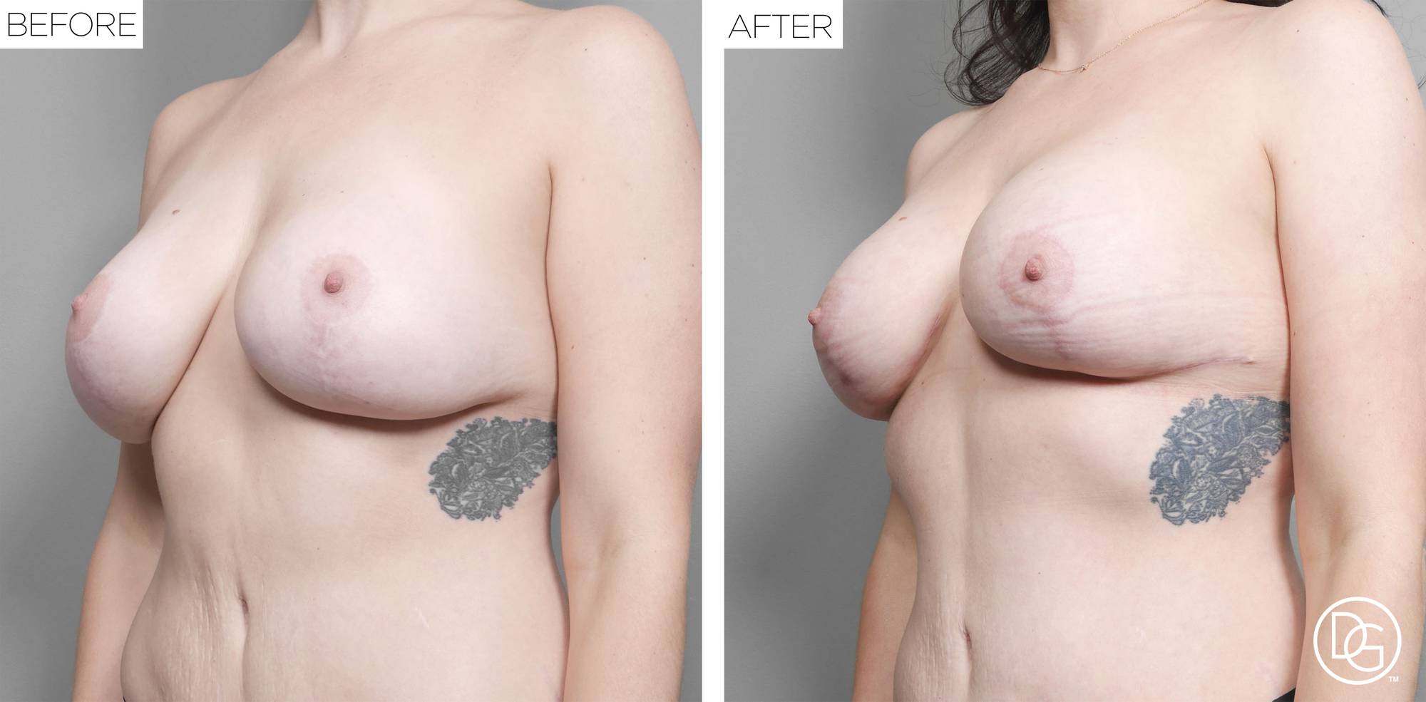Breast Revision Before & After Image