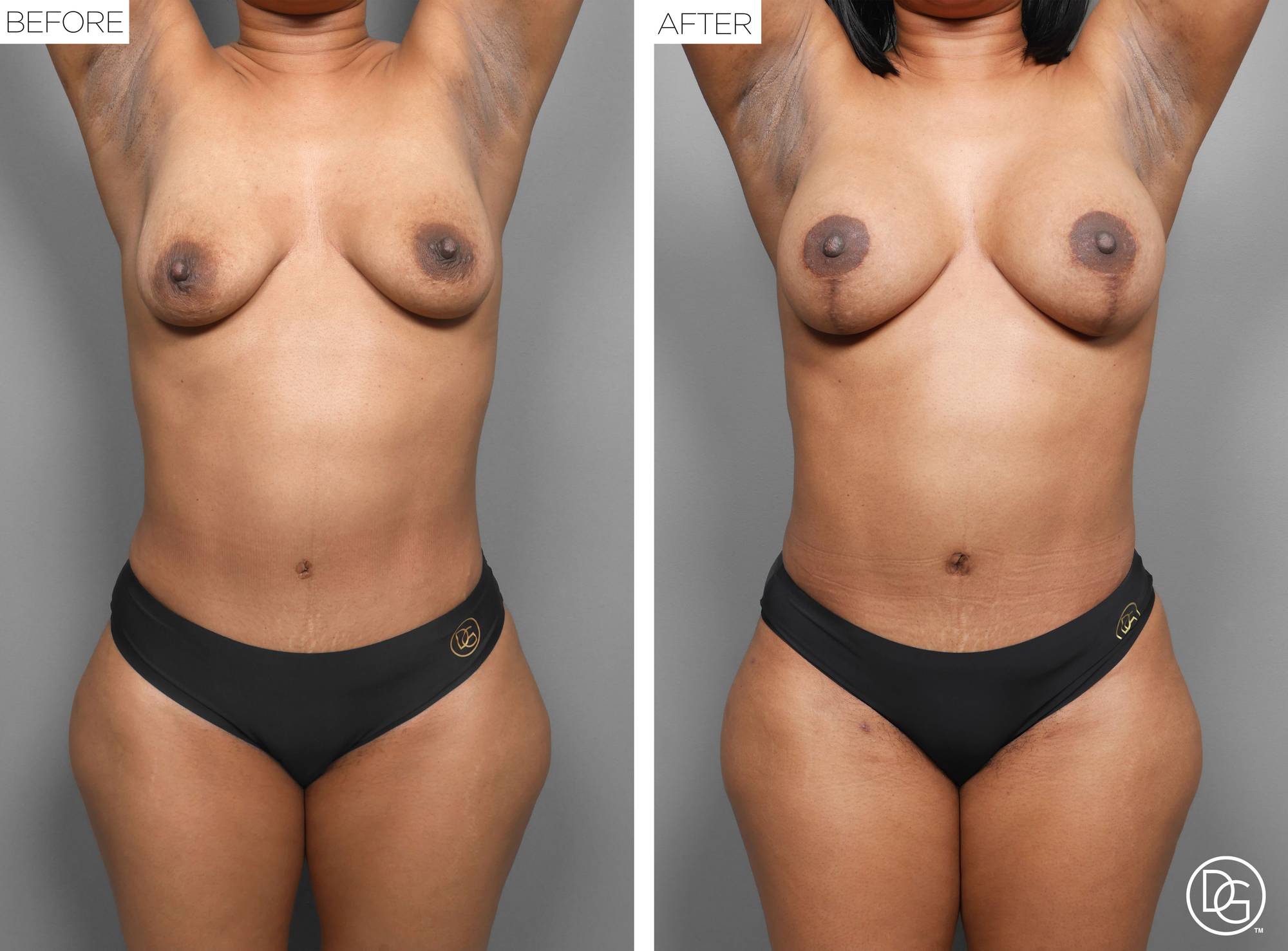 Liposuction Before & After Image