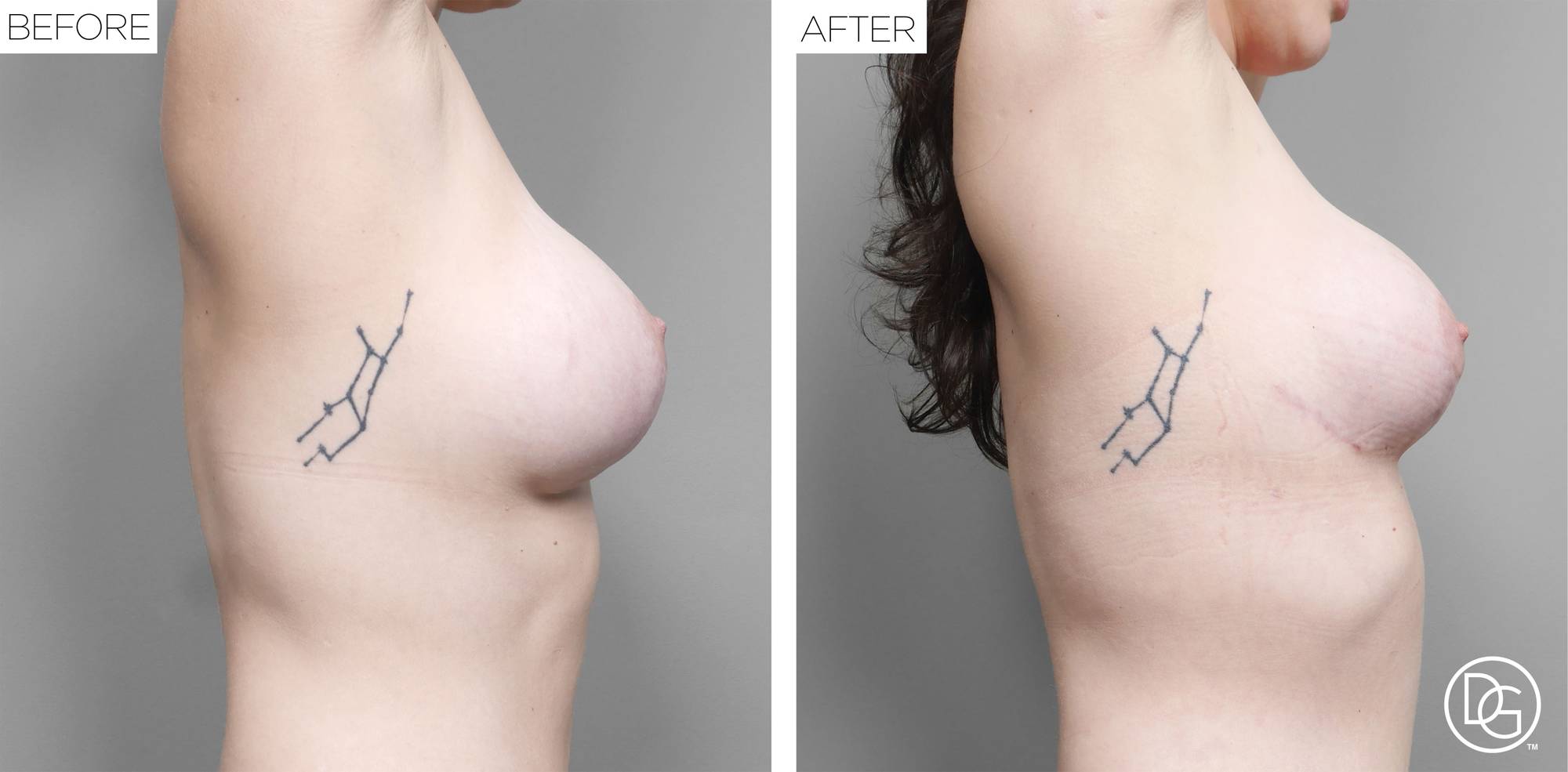 Breast Revision Before & After Image