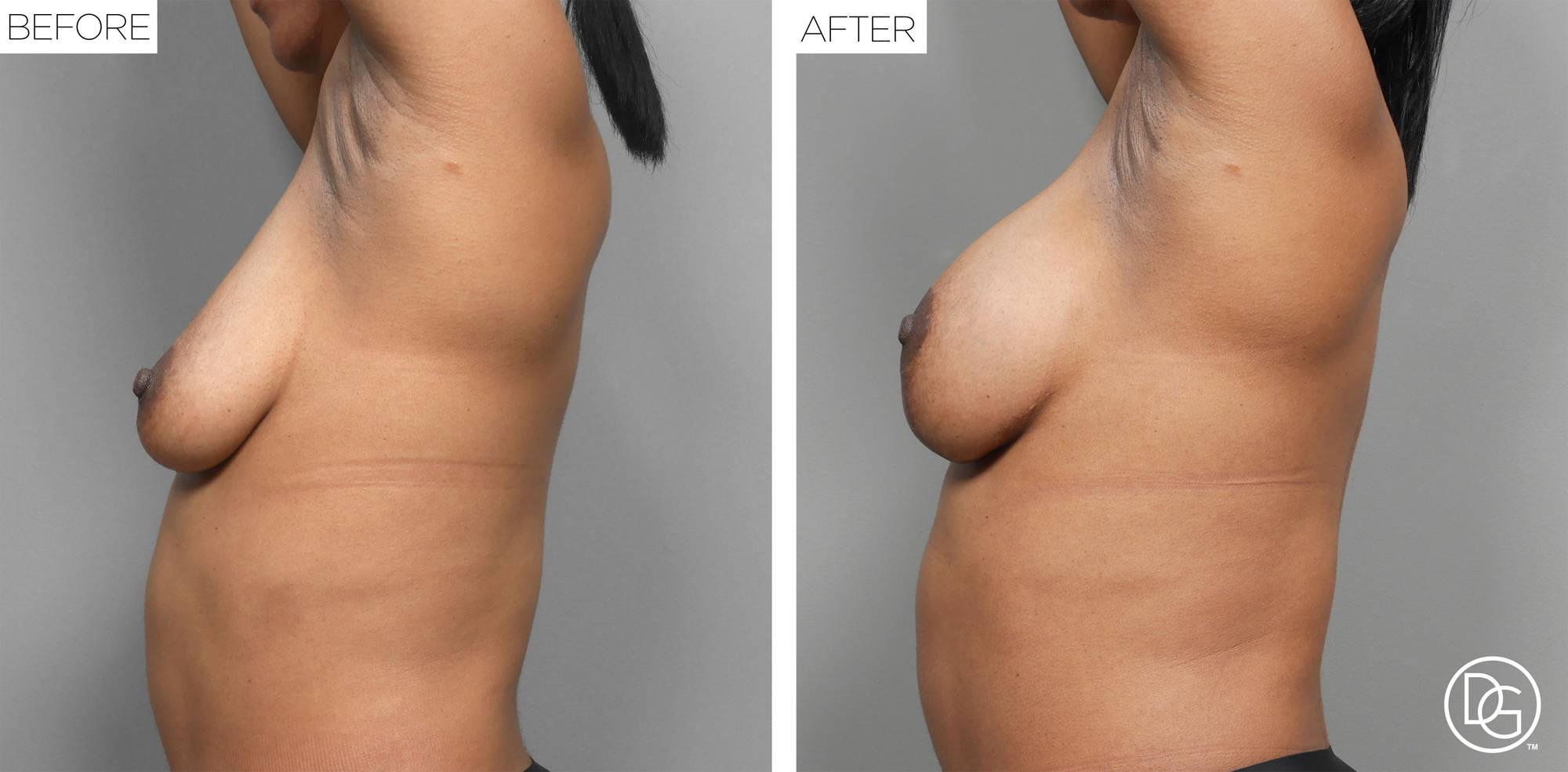 Breast Lift Before & After Image