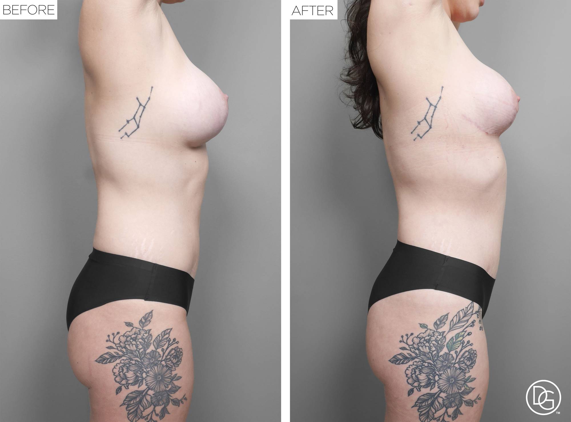 Liposuction Before & After Image