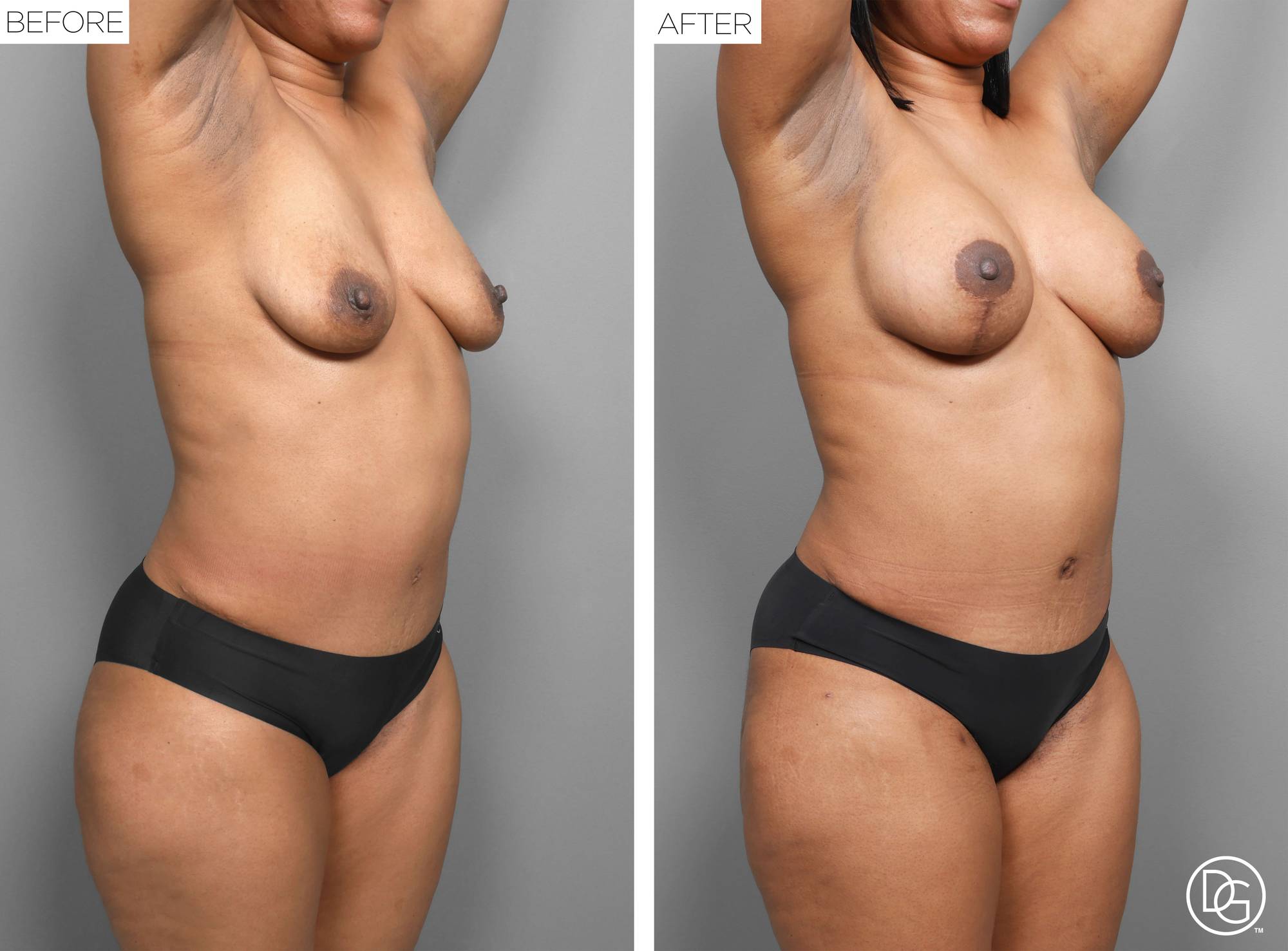 Liposuction Before & After Image