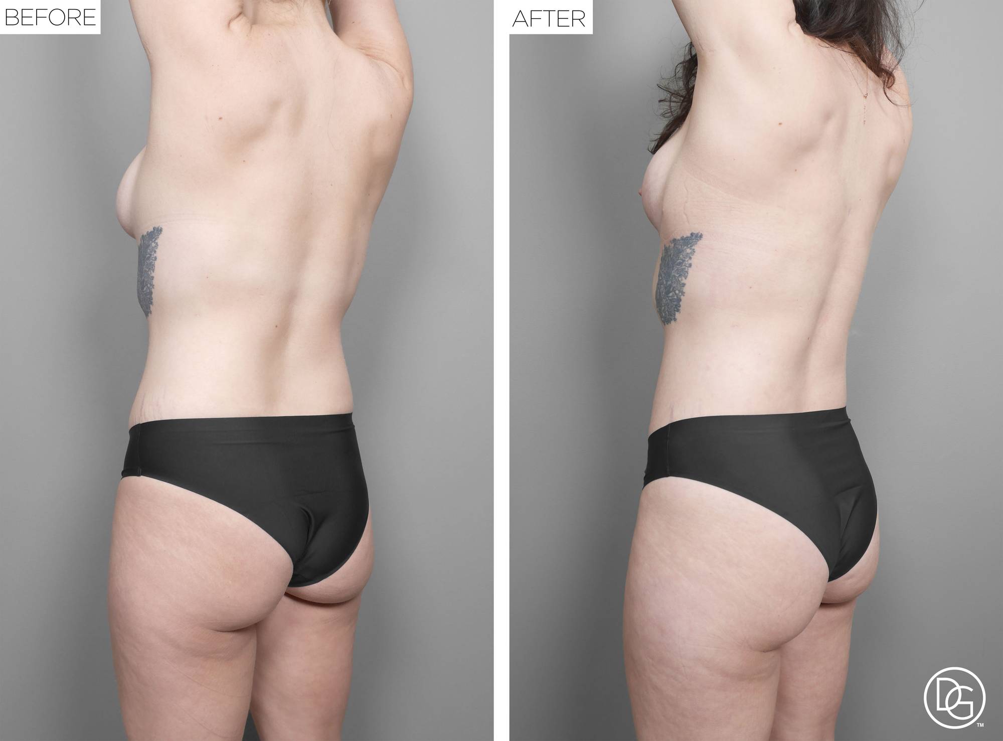 Liposuction Before & After Image