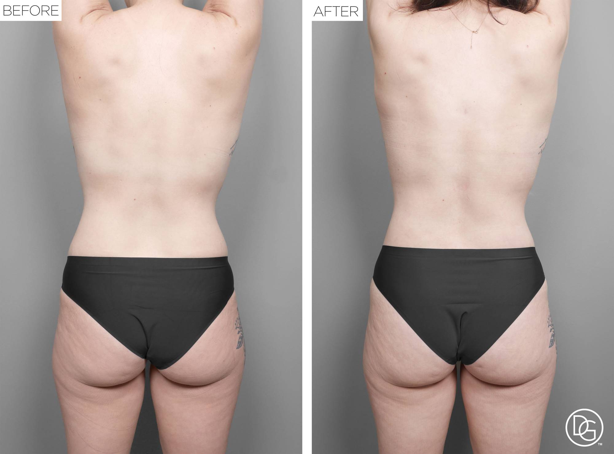Liposuction Before & After Image