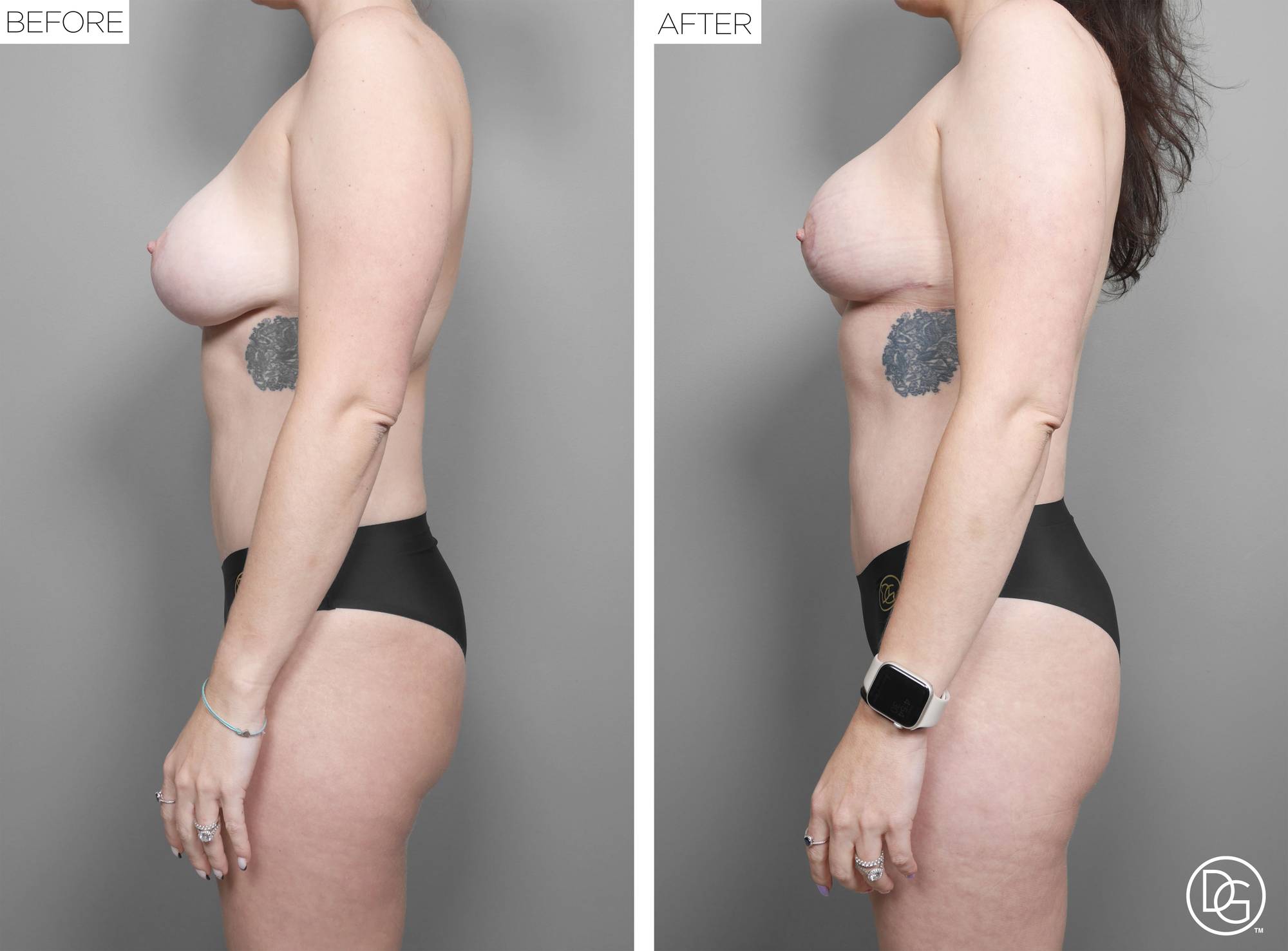 Liposuction Before & After Image
