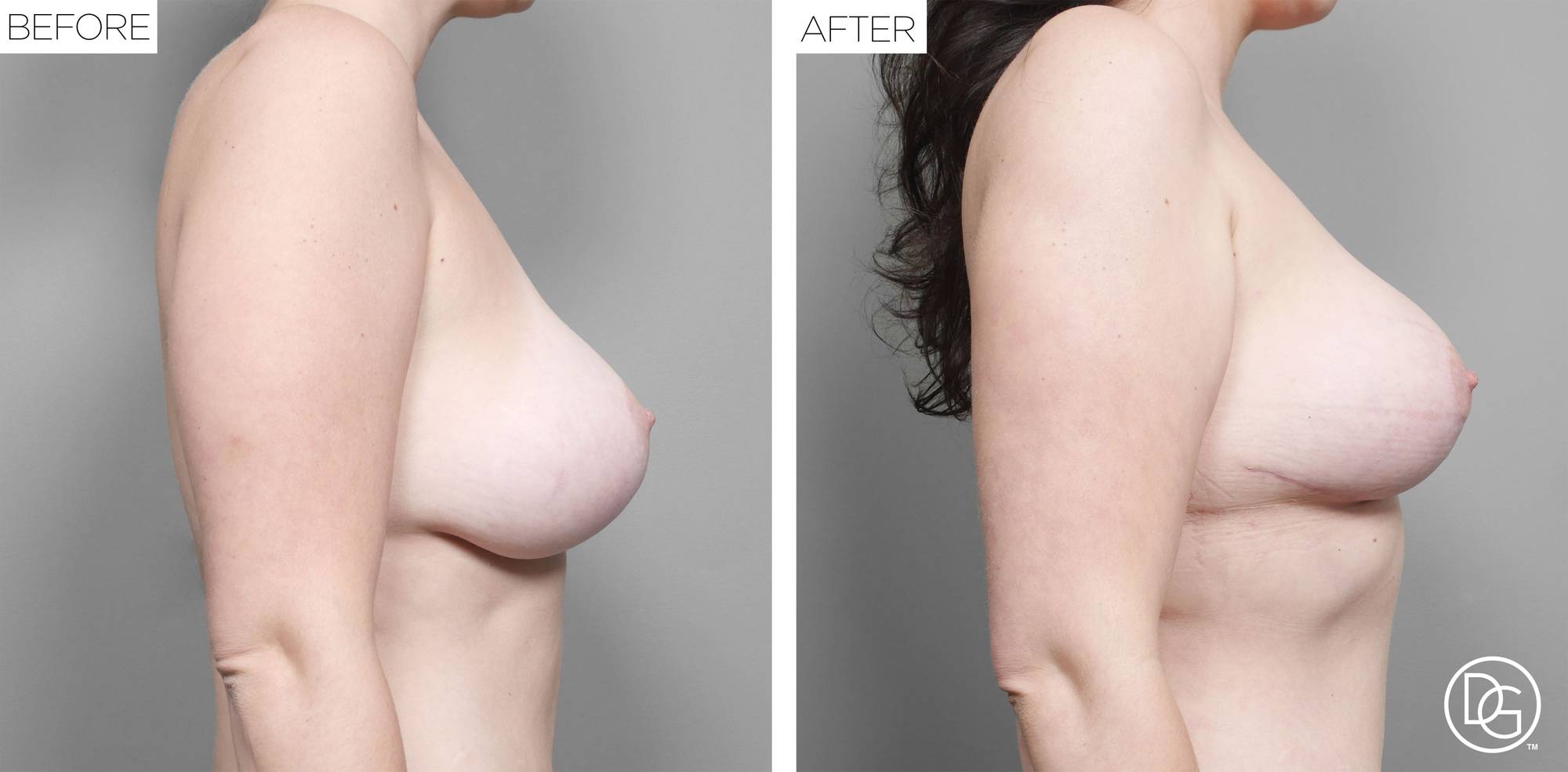 Breast Revision Before & After Image