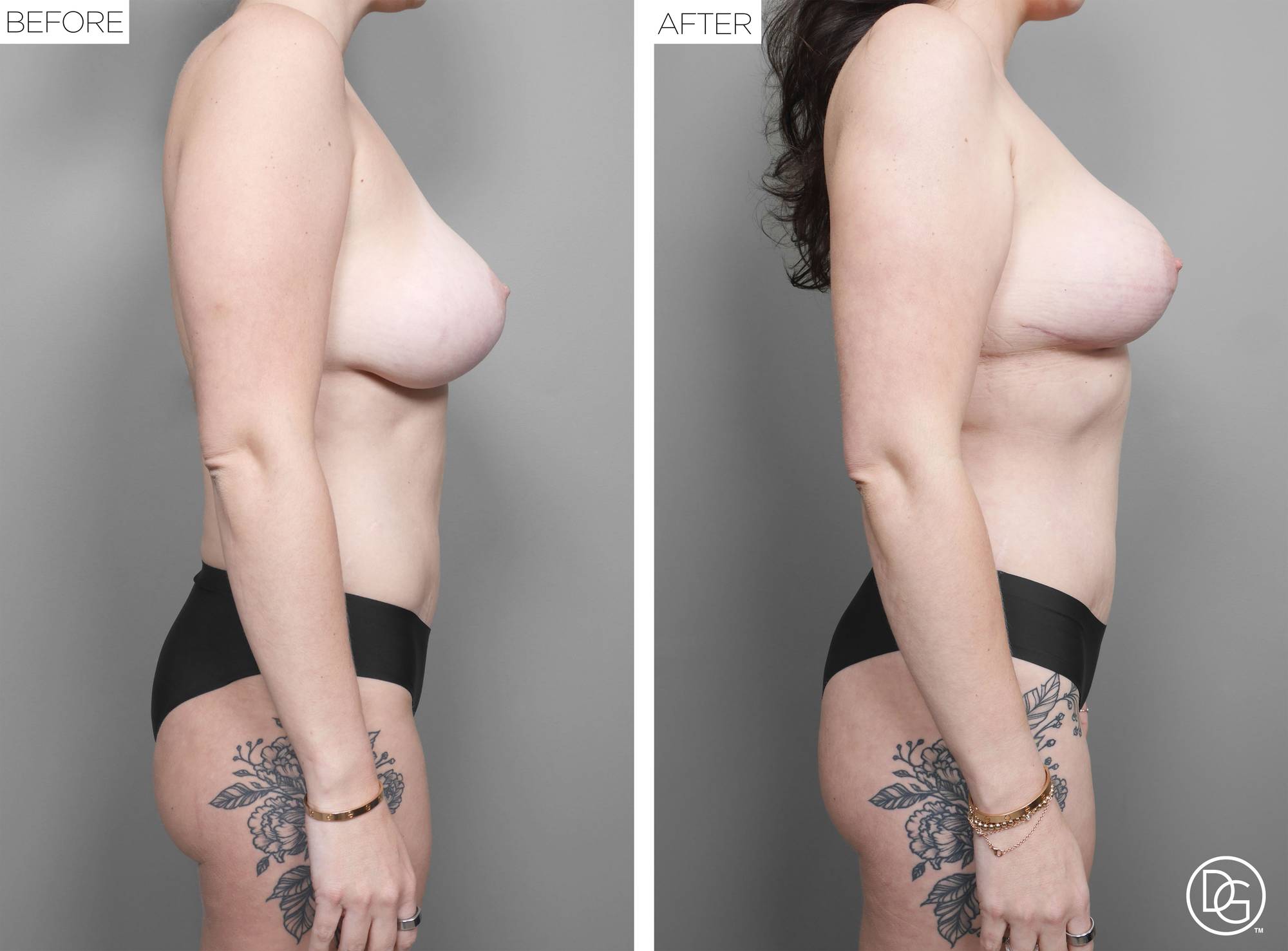 Liposuction Before & After Image