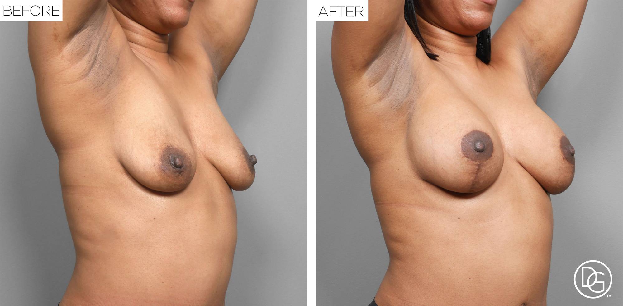Breast Lift Before & After Image