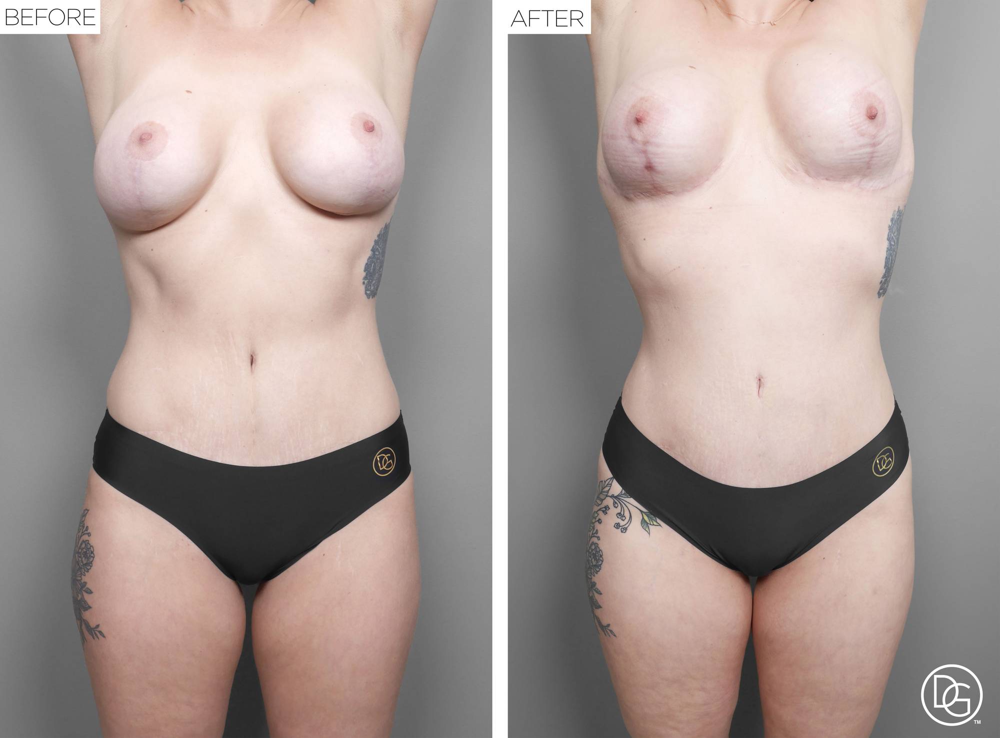 Liposuction Before & After Image