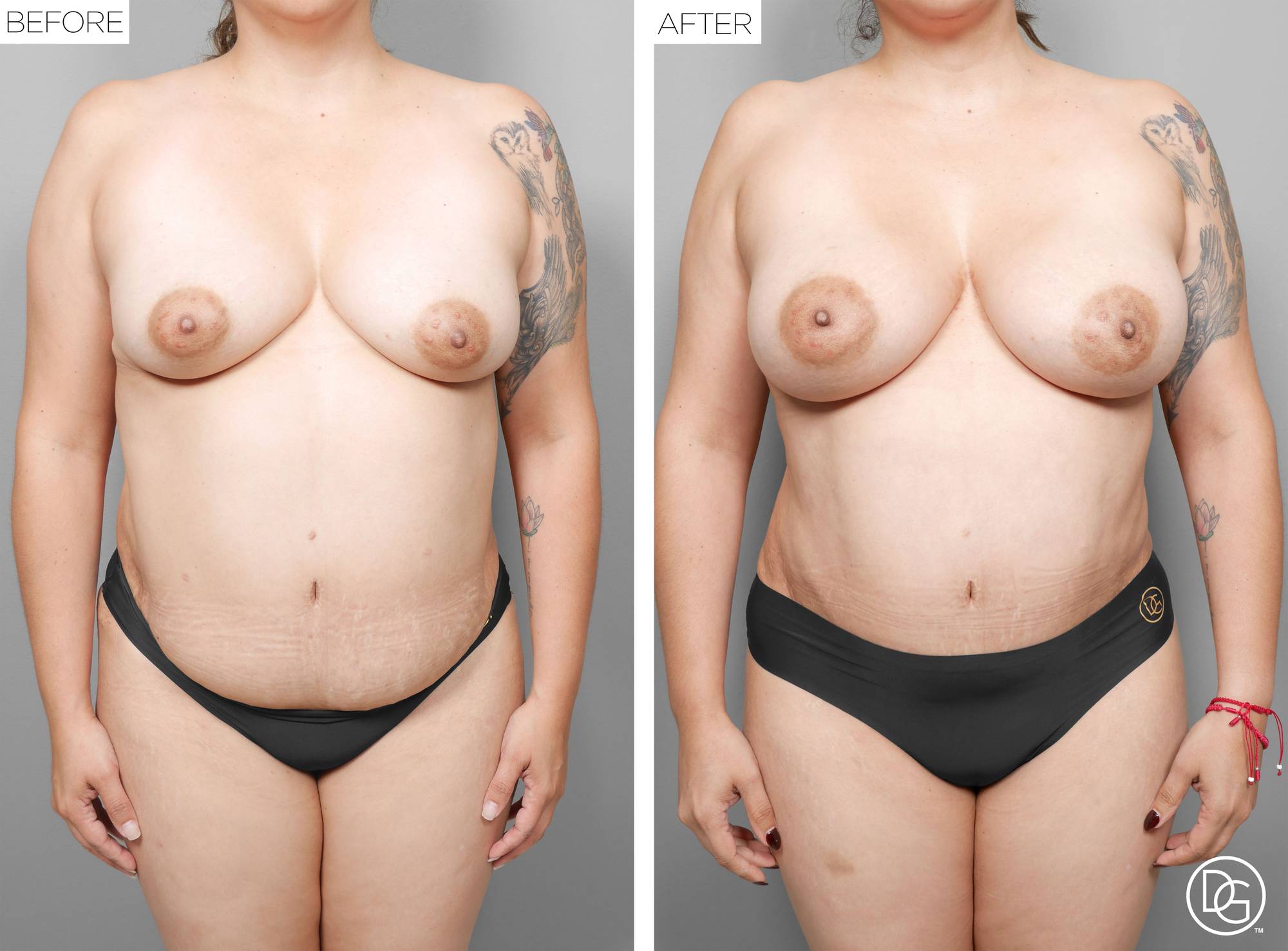 Liposuction Before & After Image