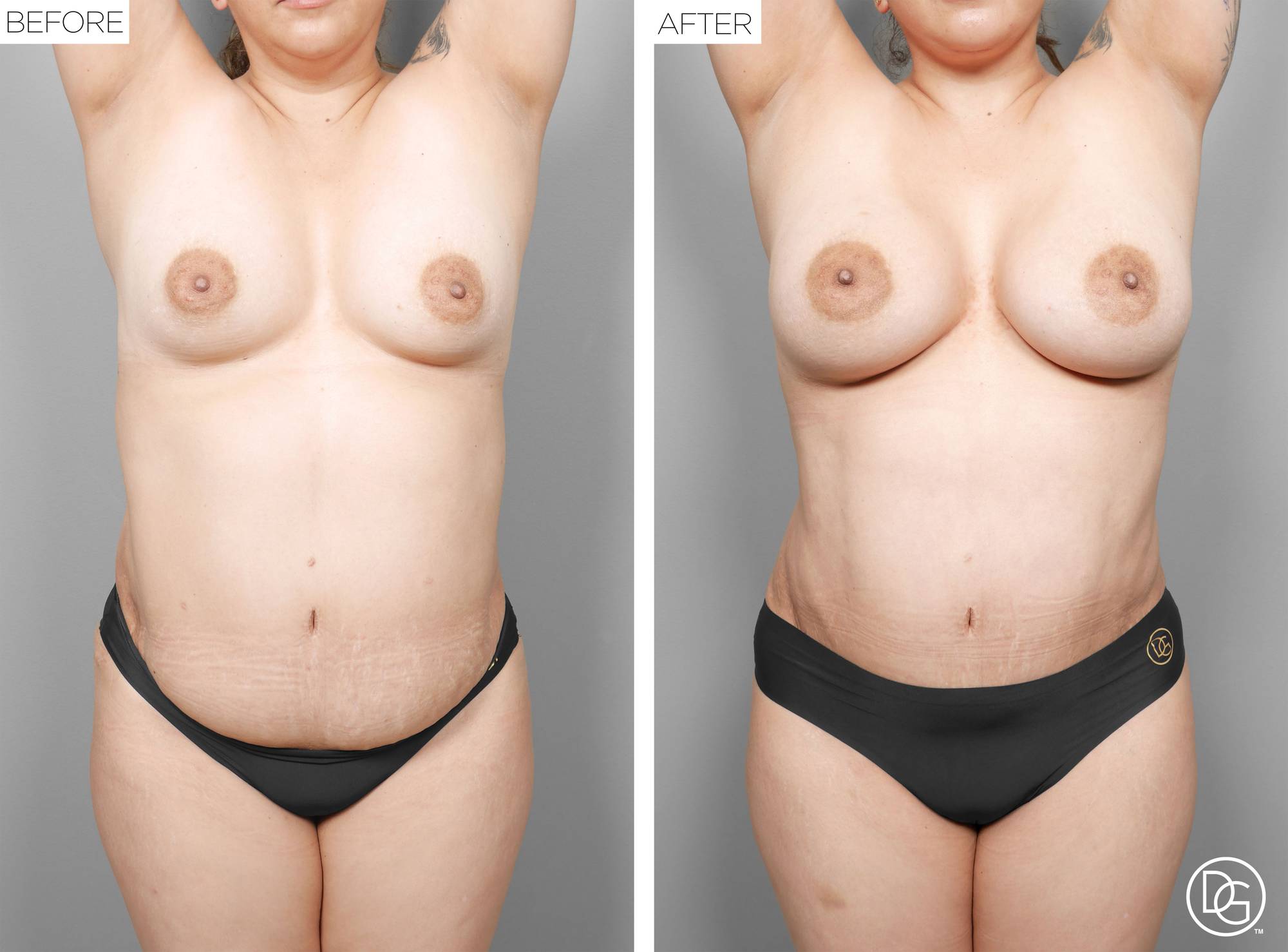Liposuction Before & After Image
