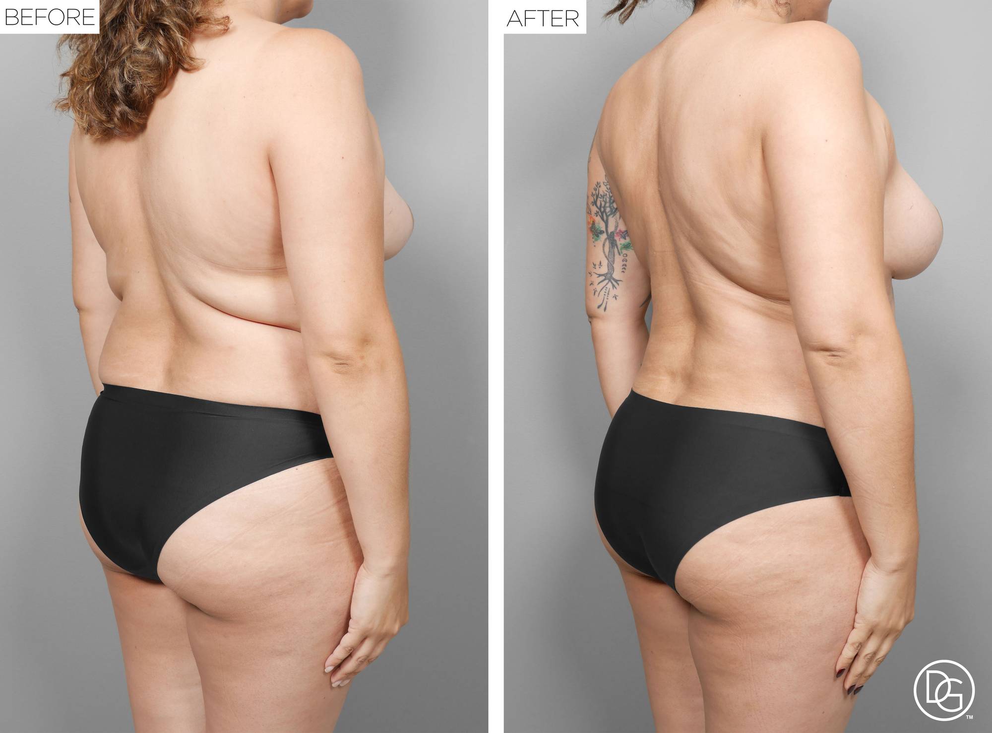 Liposuction Before & After Image