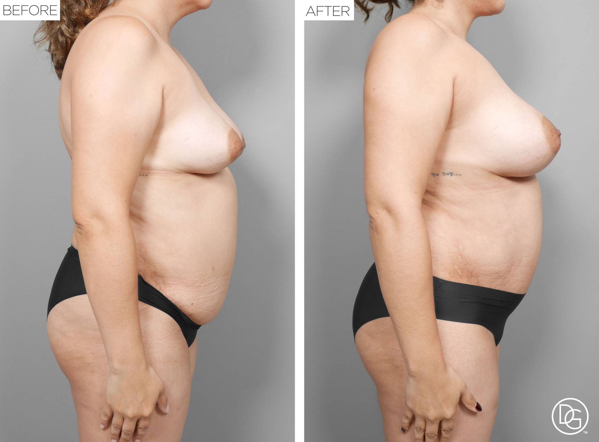 Liposuction Before & After Image